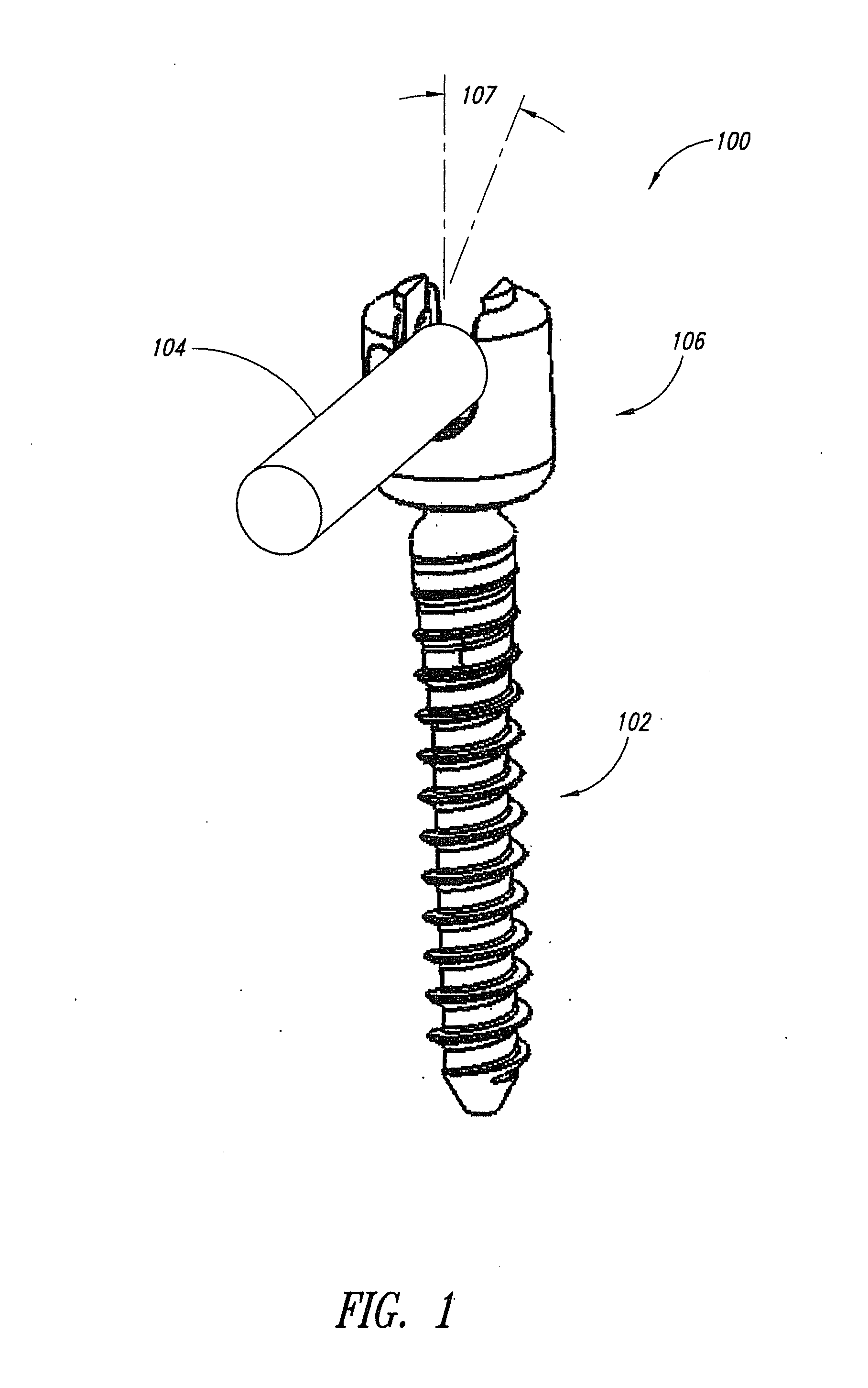 Pedicle Screw Systems and Methods of Assembling/Installing the Same