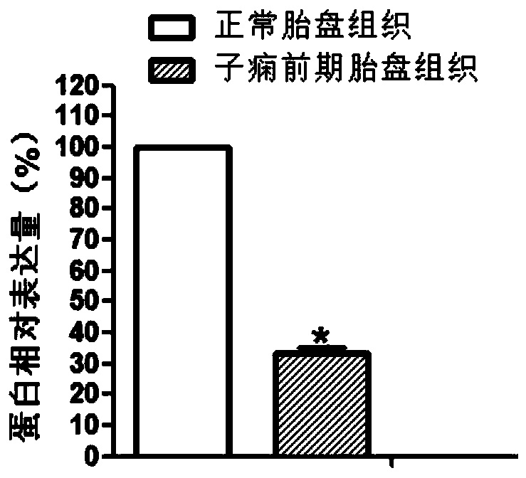 Genetic markers of preeclampsia