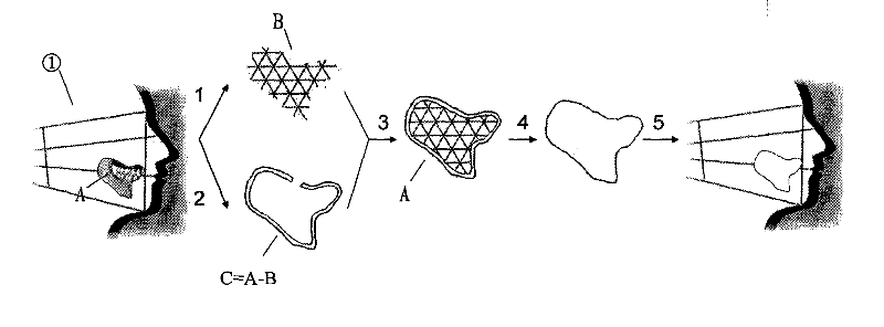 Complex-shaped gel-metal composite prosthesis and manufacturing method thereof