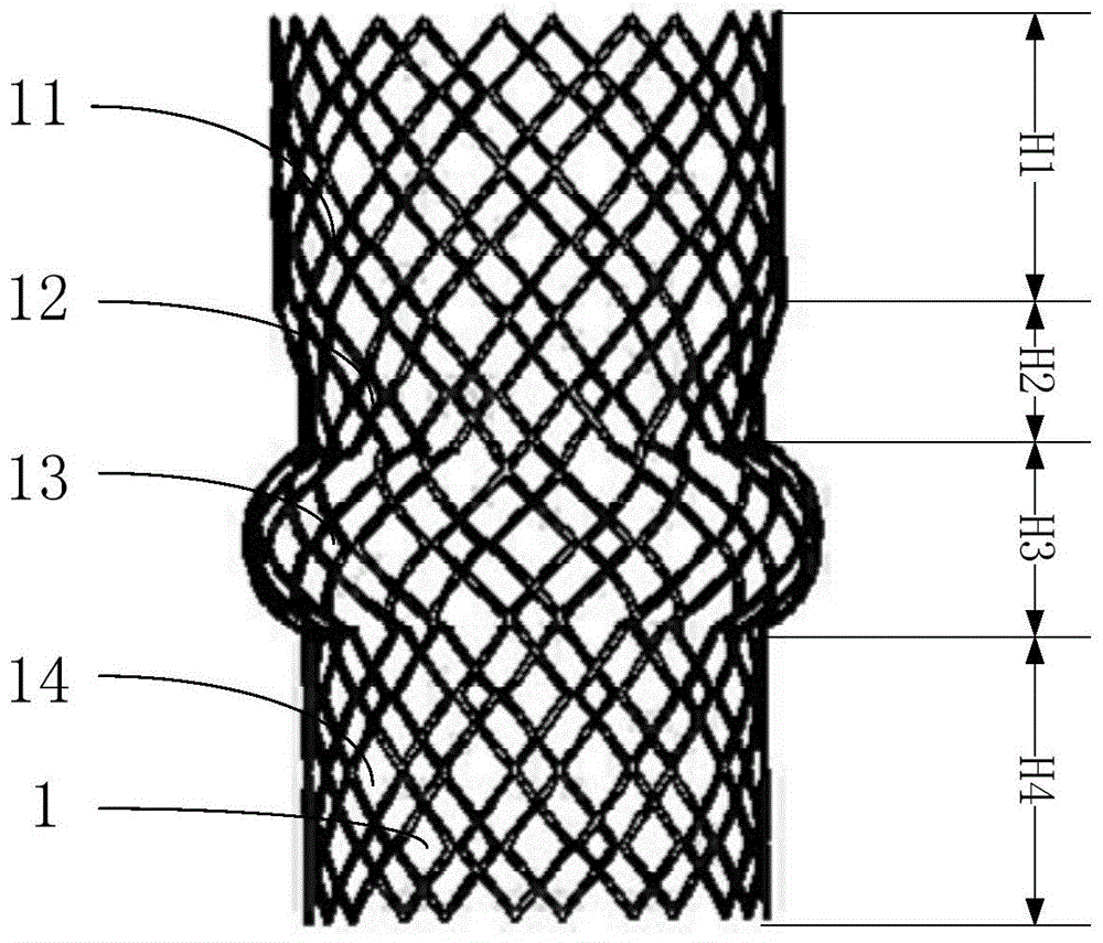 A liquid-filled cage ball type aortic valve stent system