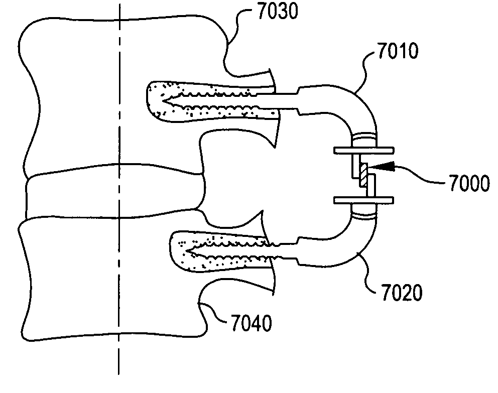 Crossbar spinal prosthesis having a modular design and related implantation methods