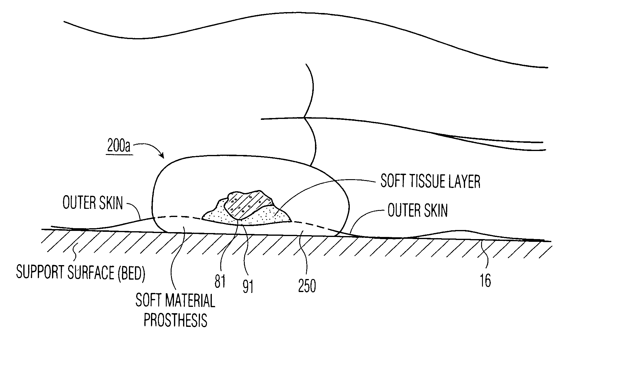 Apparatus and methods for preventing and/or healing pressure ulcers