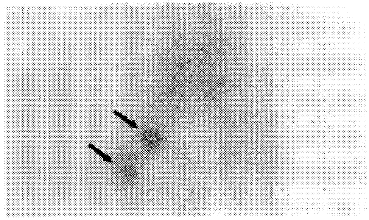 Radioimmunotherapy of lymphoma using anti-CD20 antibodies