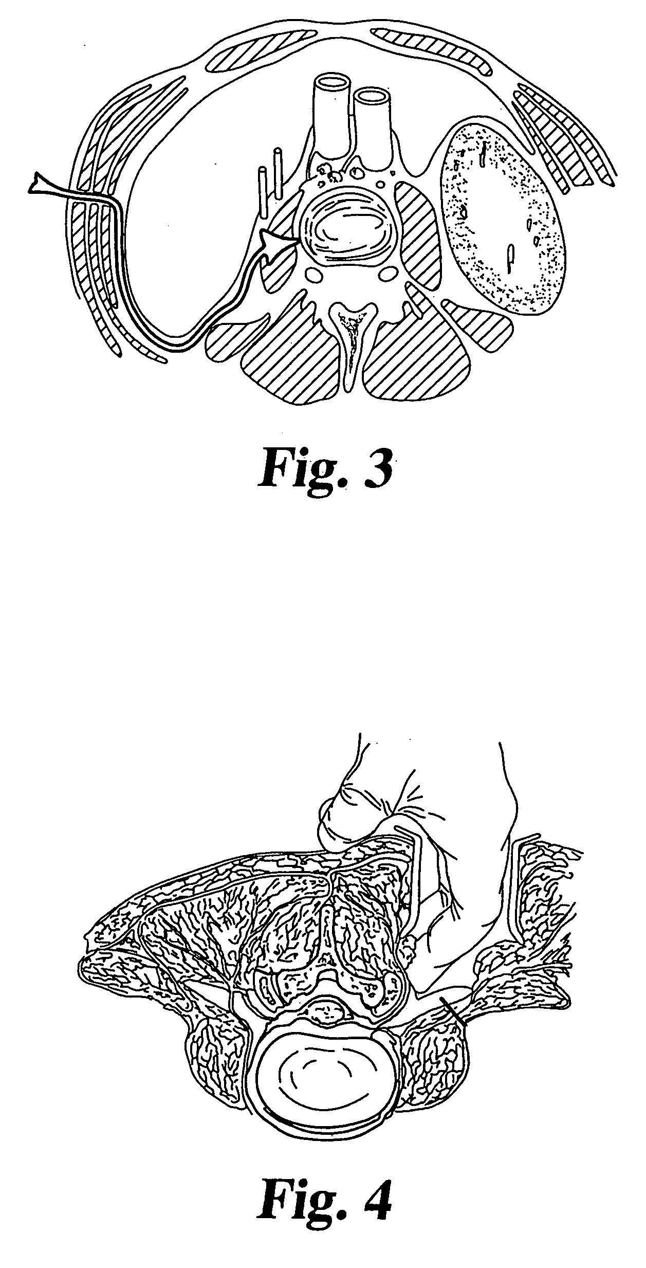 Apparatus and kit for injecting a curable biomaterial into into an intervertebral space