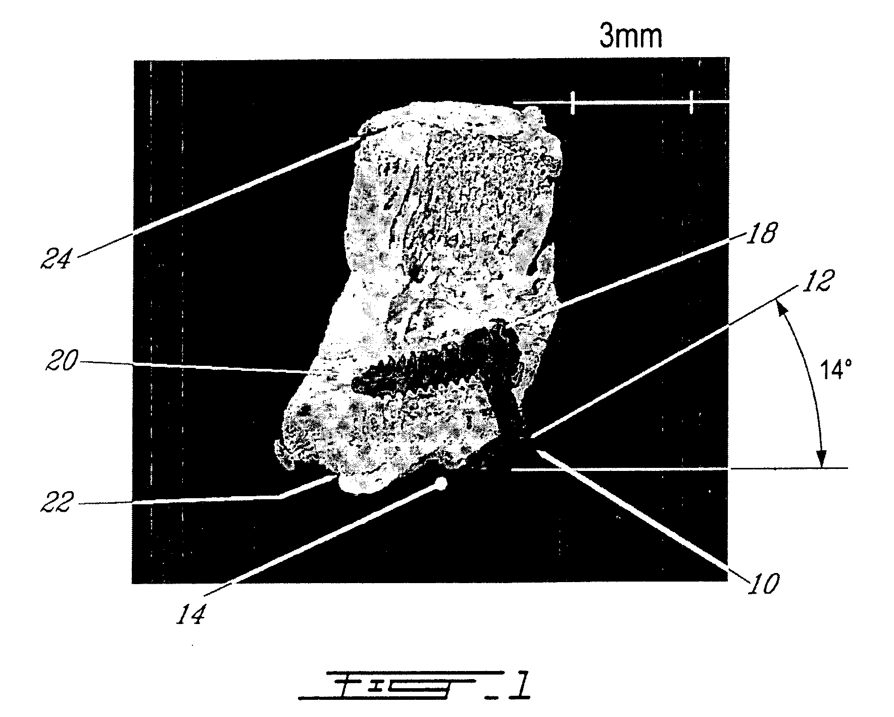 Fusionless Vertebral Physeal Device and Method