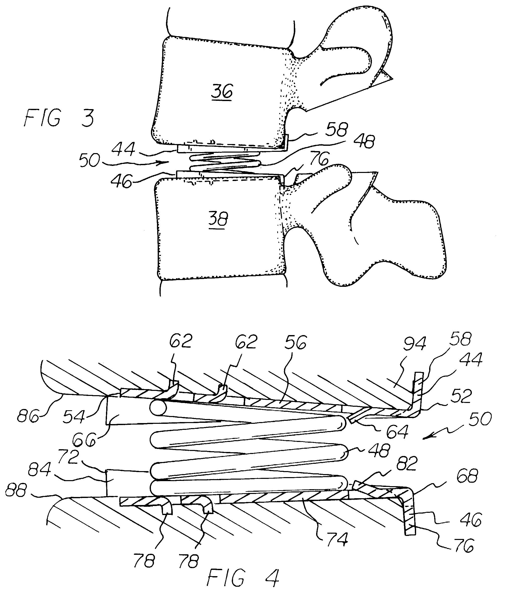 Vertebral implant with dampening matrix adapted for posterior insertion
