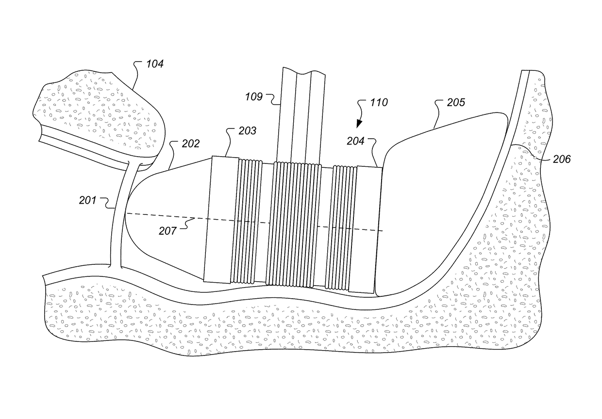 S-Shaped Coupling Spring for Middle Ear Implants