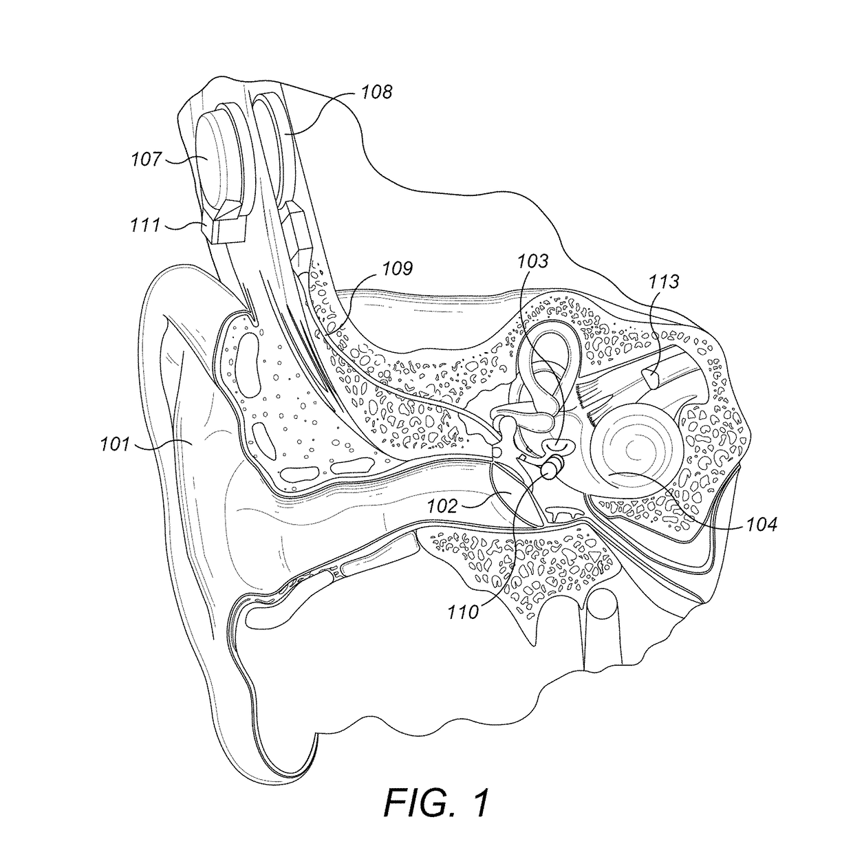 S-Shaped Coupling Spring for Middle Ear Implants