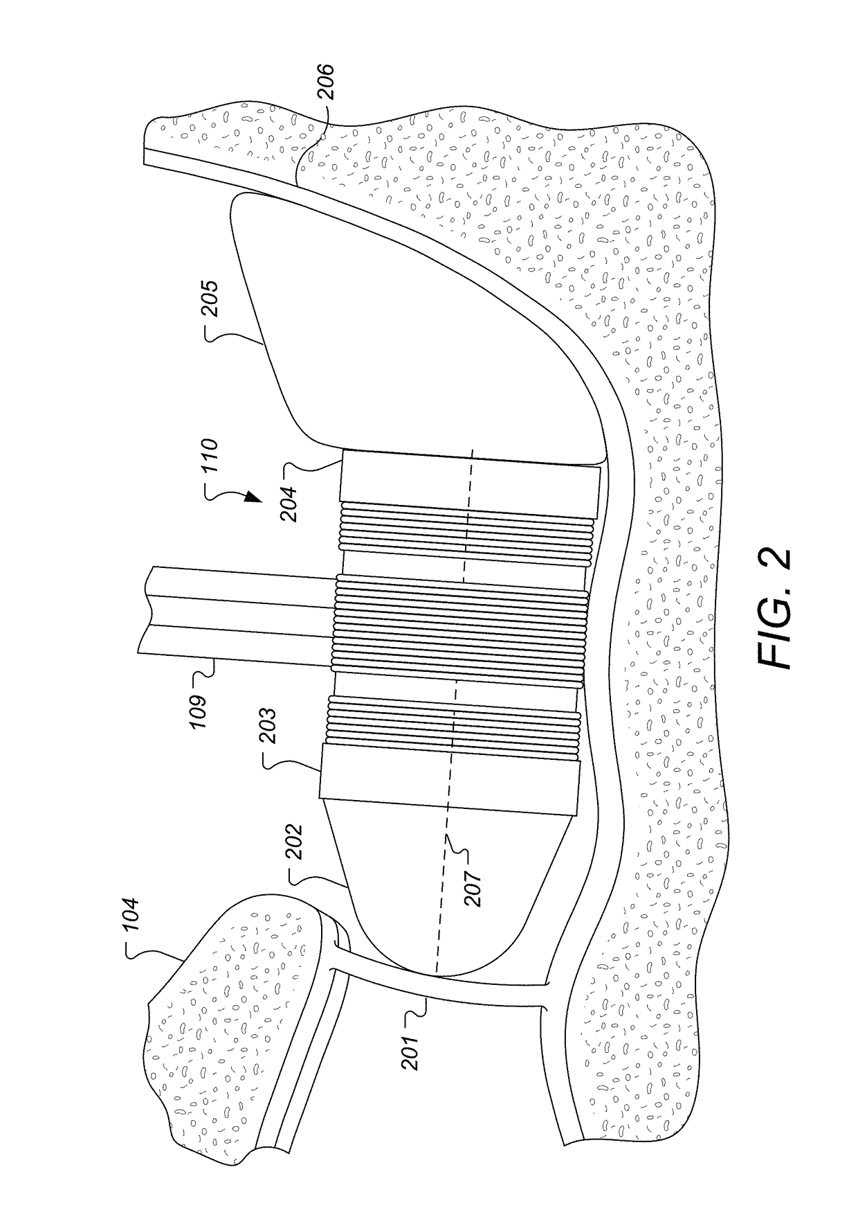 S-Shaped Coupling Spring for Middle Ear Implants