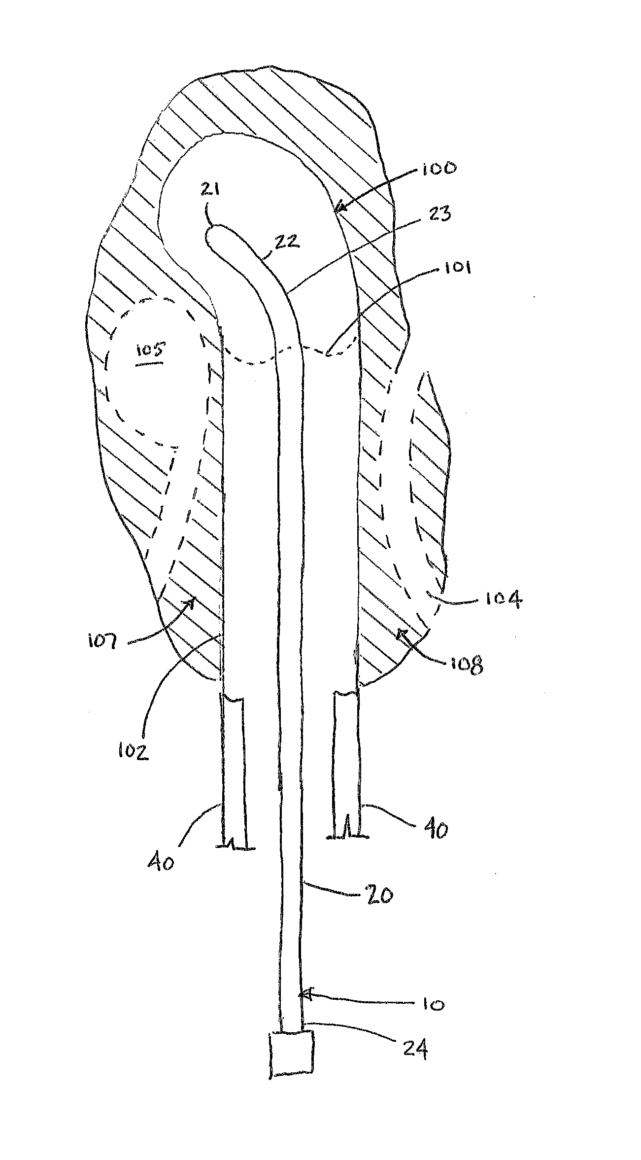 Intracavitary Brachytherapy Device for Insertion in a Body Cavity and Methods of Use Thereof