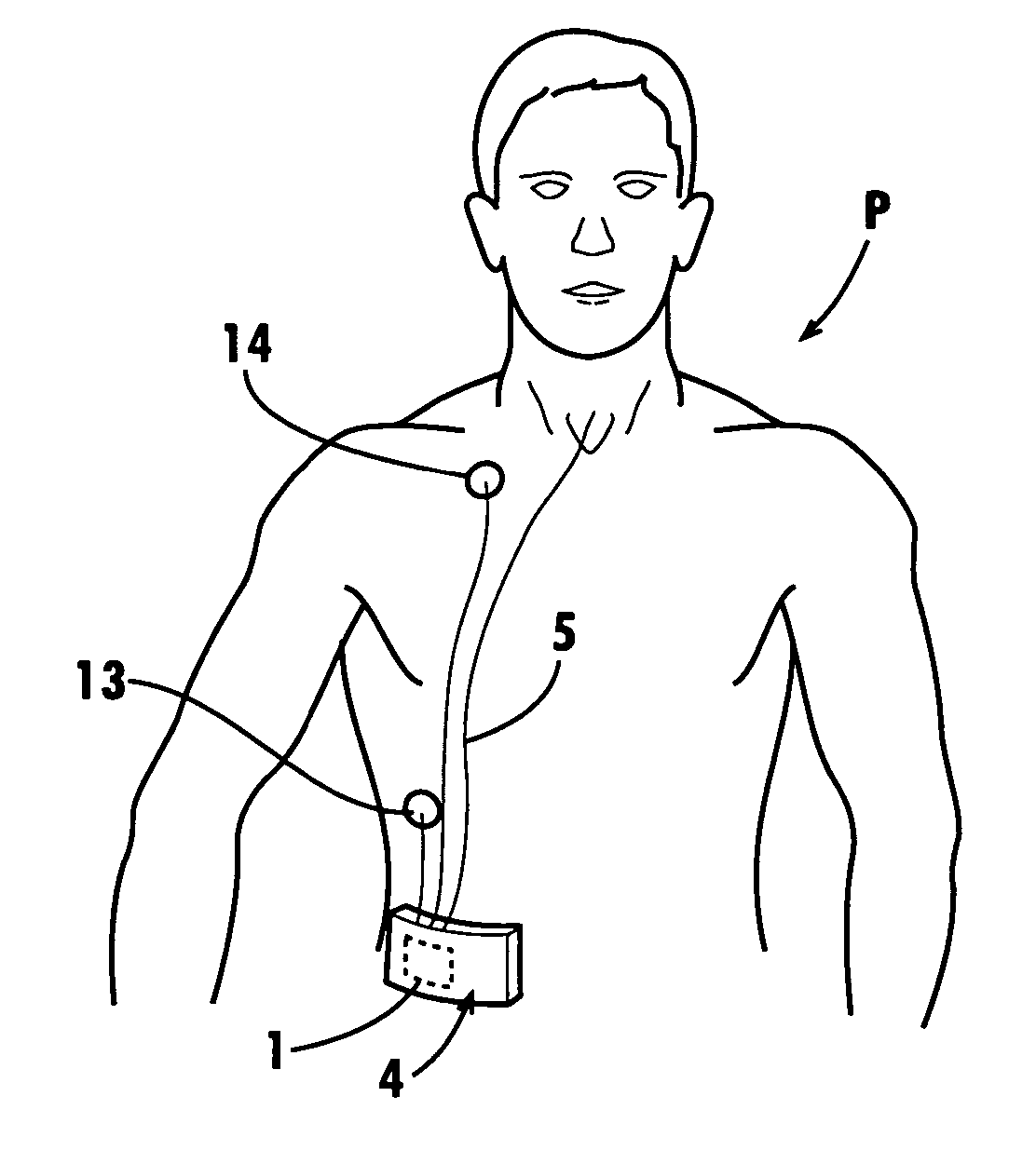 Tracheal catheter and prosthesis and method of respiratory support of a patient