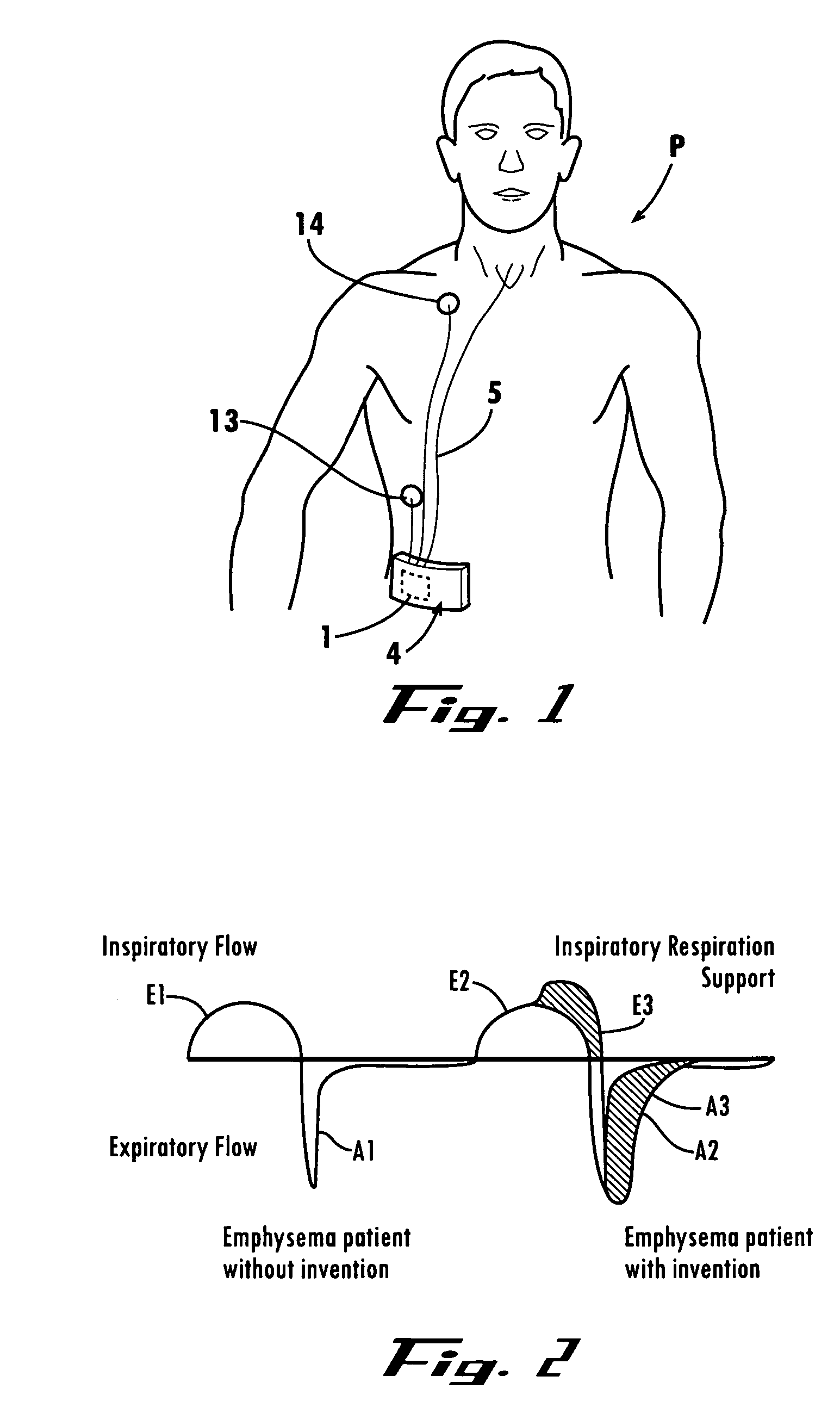 Tracheal catheter and prosthesis and method of respiratory support of a patient