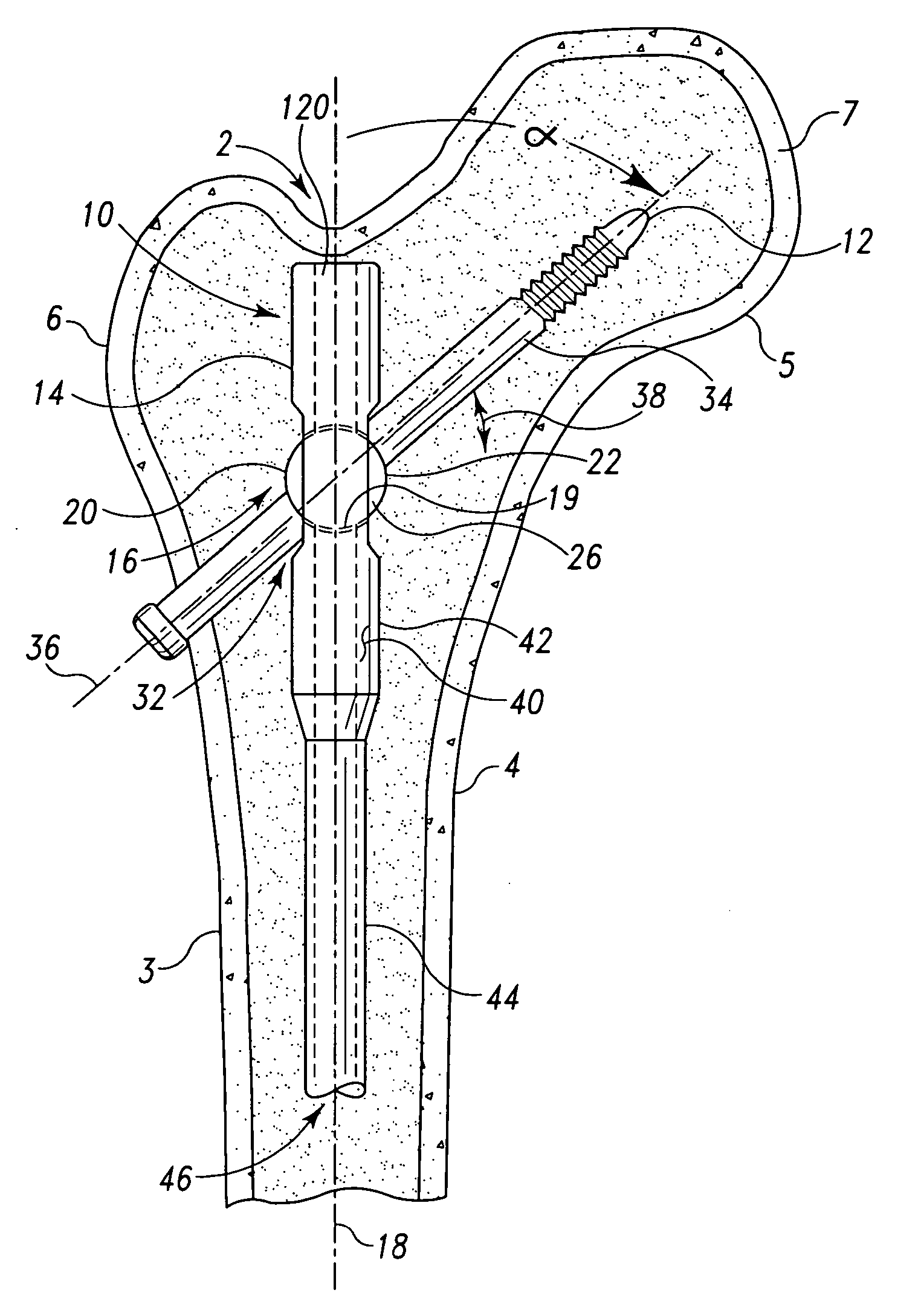 Variable angle fixture, kit and method of presetting a nail assembly