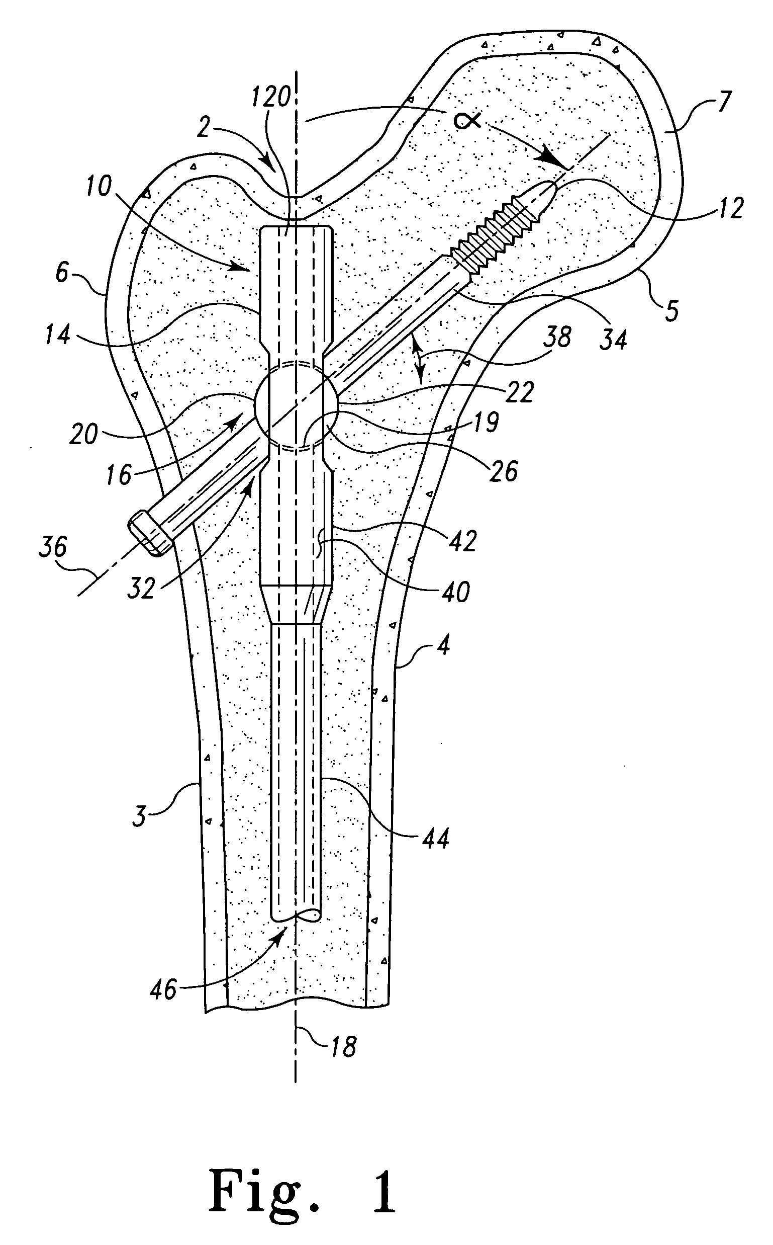 Variable angle fixture, kit and method of presetting a nail assembly