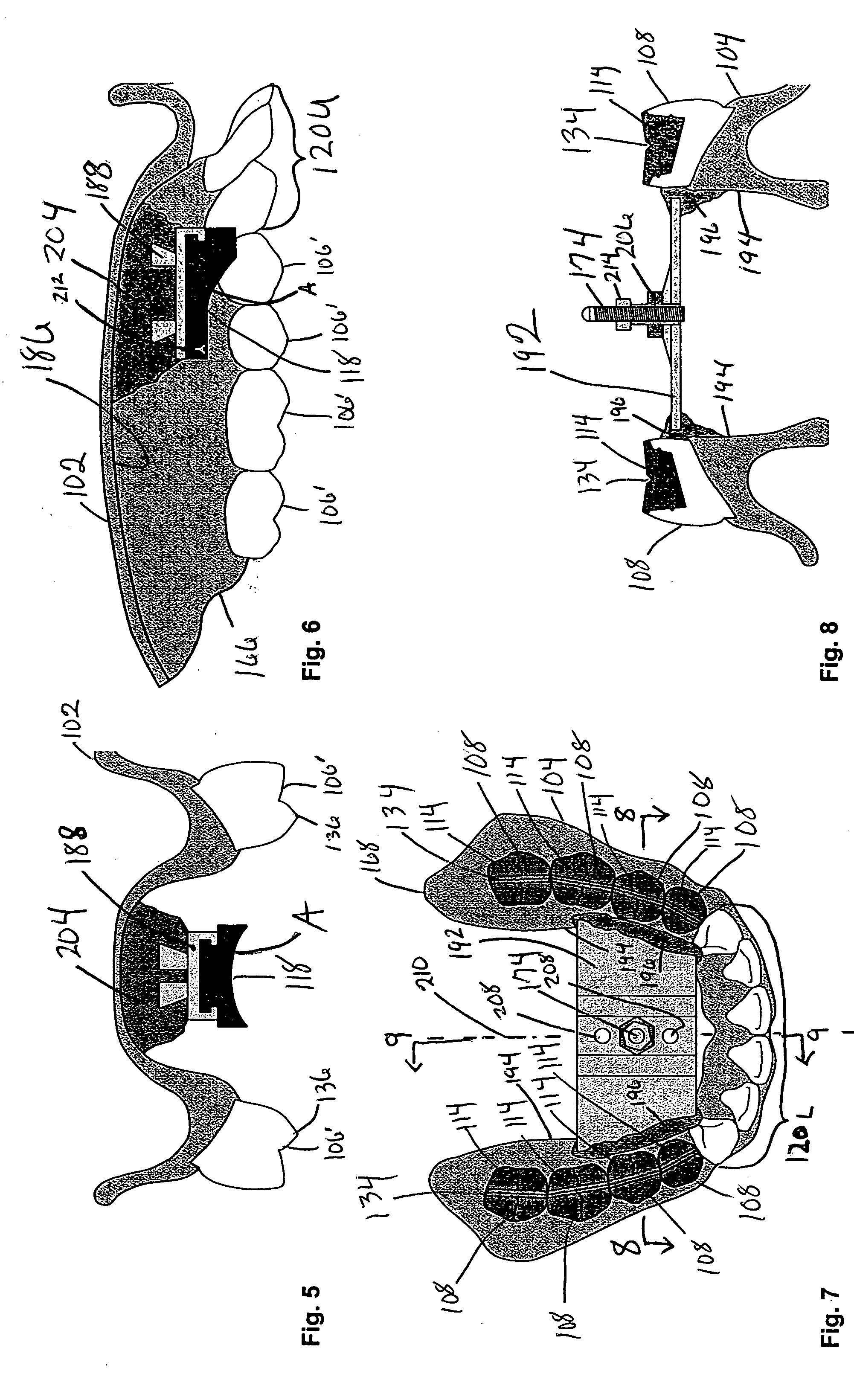 Method for developing balanced occlusion in dentistry