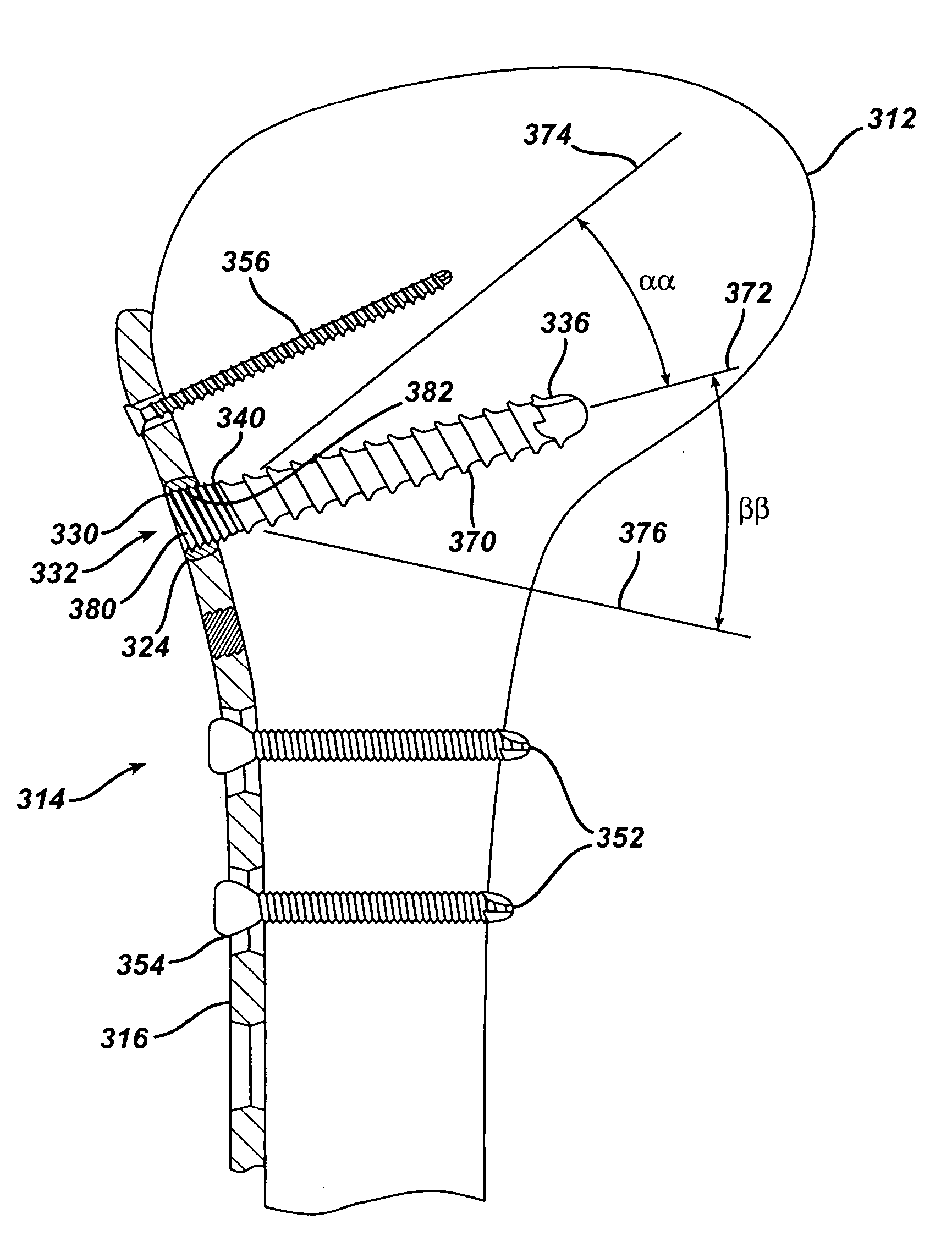 Dual locking plate and associated method