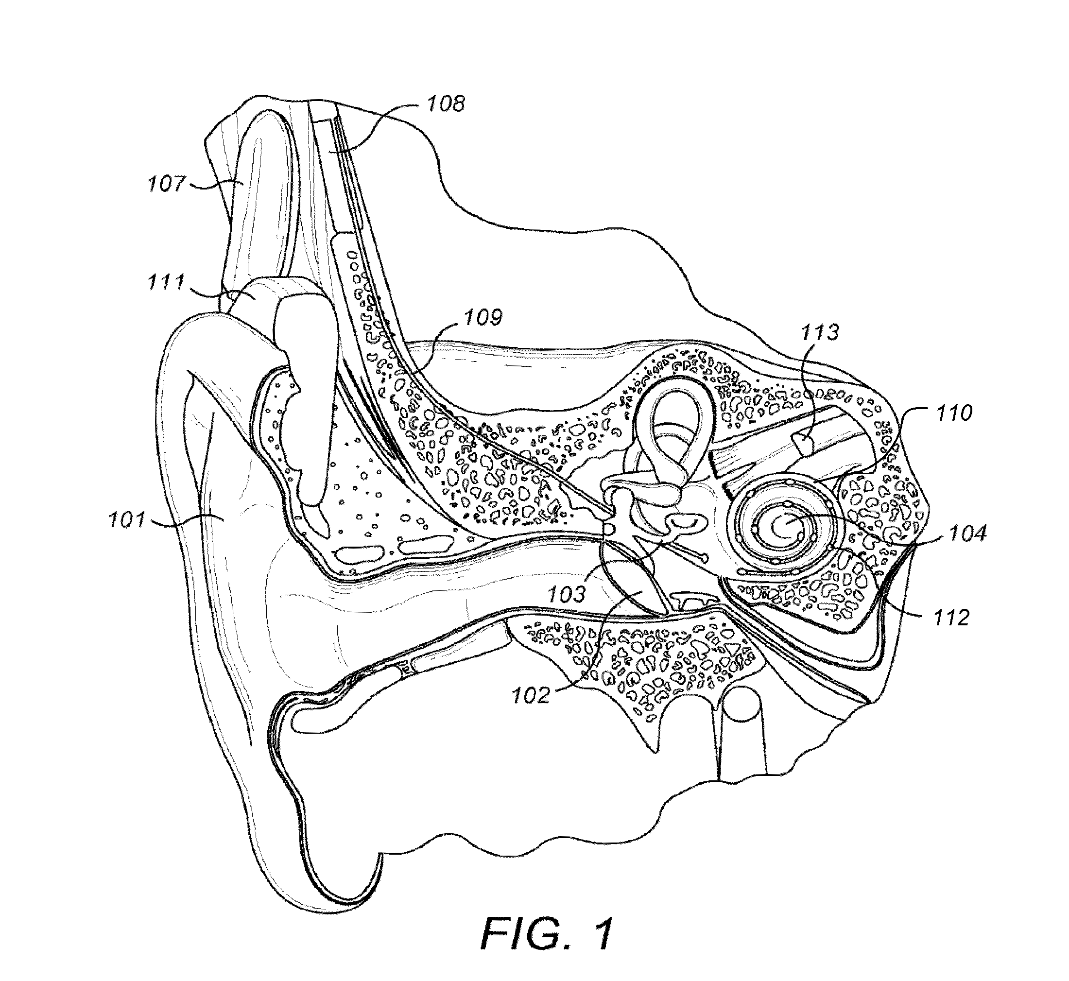 Cochlear Electrode With Apical Lateral Wall Section and Basal Modiolar Hugging Section