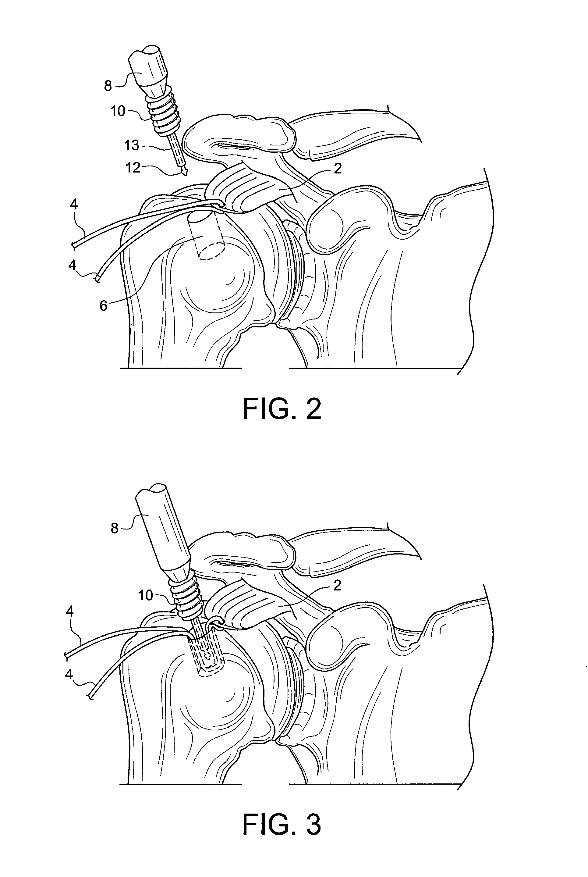 Knotless anchor for surgical repair