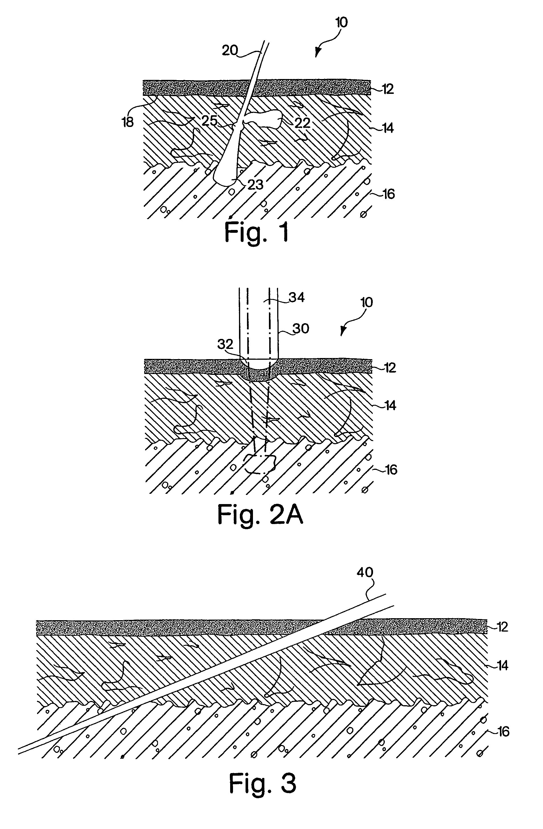 Method and apparatus for the selective targeting of lipid-rich tissues