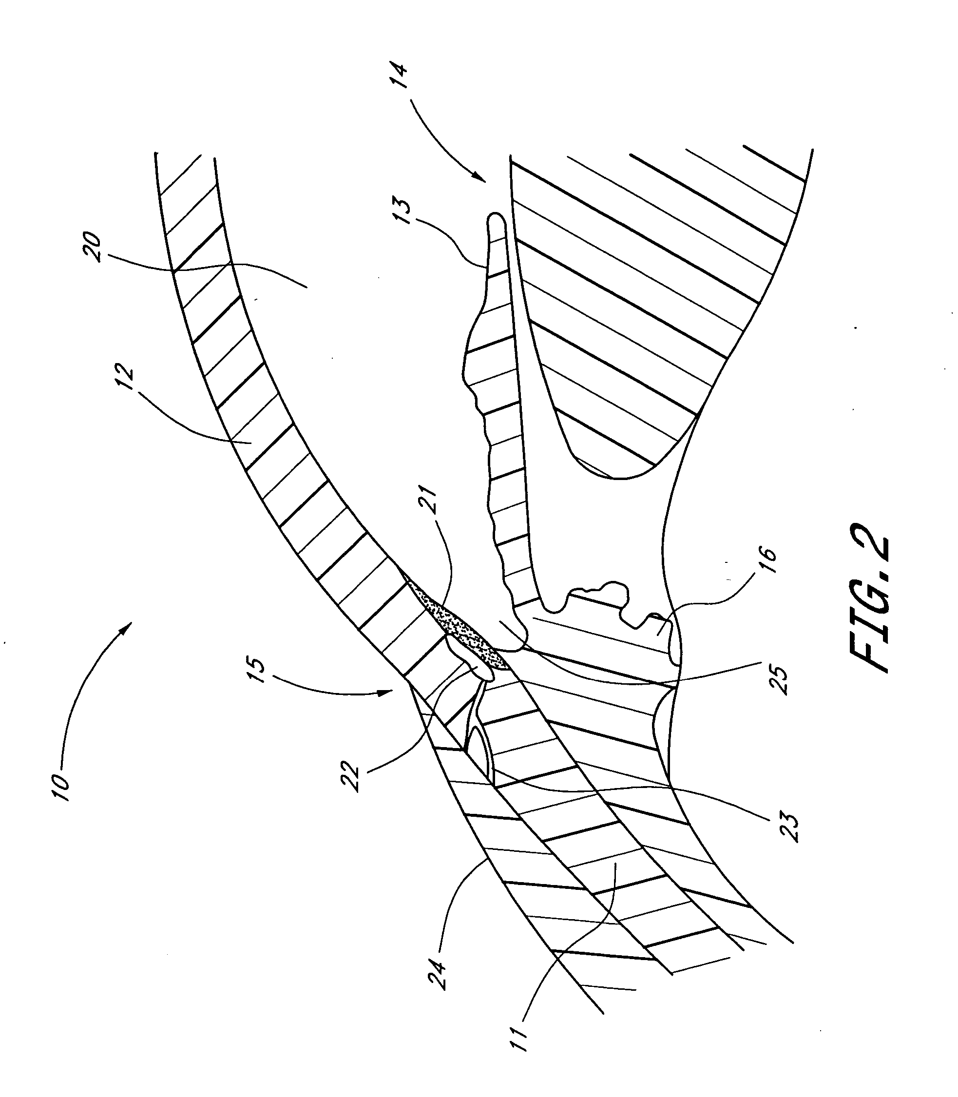 Medical device and methods of use for glaucoma treatment
