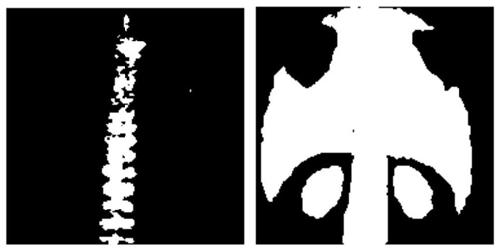 Bone scanning image hotspot segmentation method and system, medium and equipment