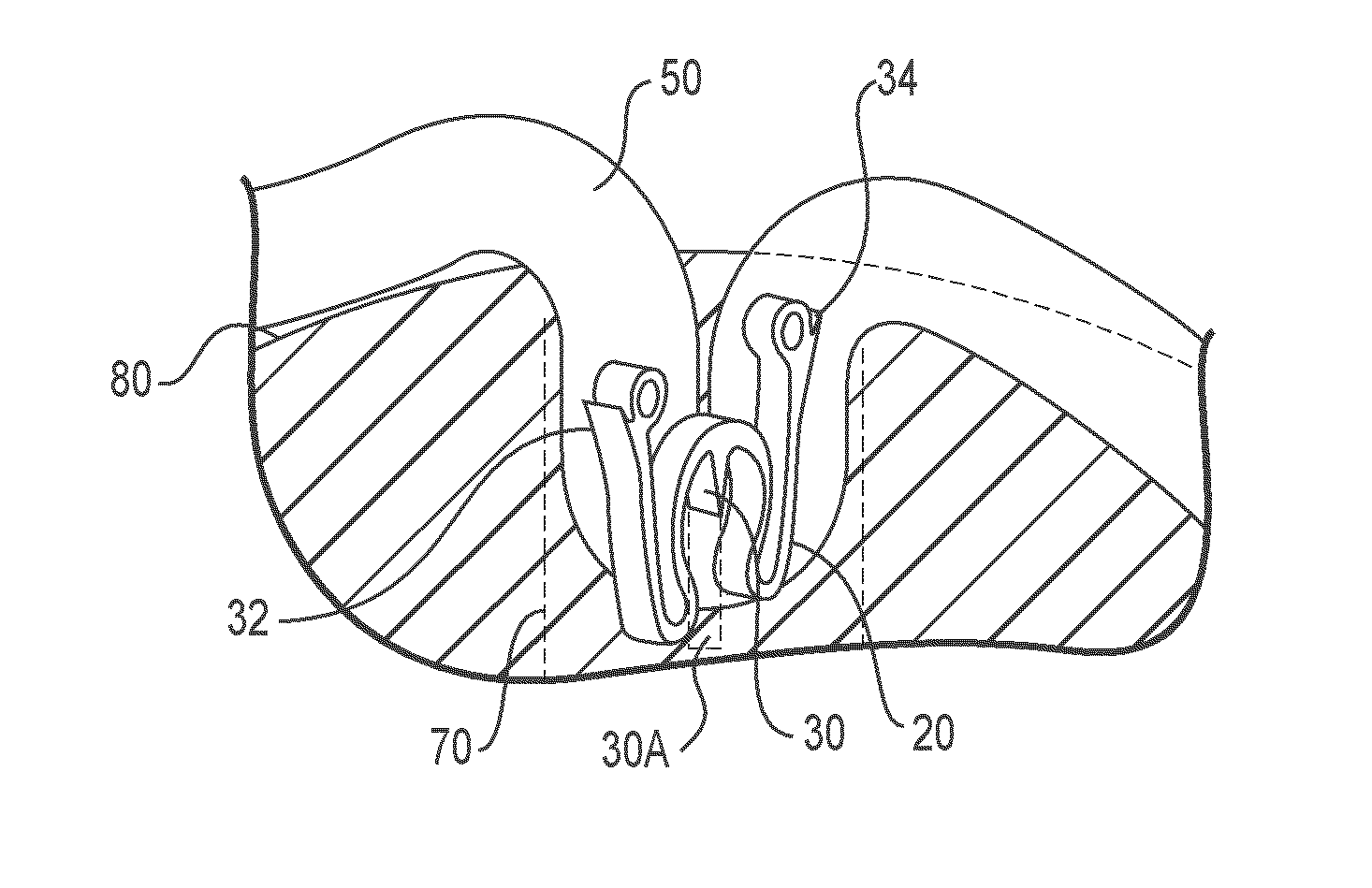 Tissue fixation system with single component anchor