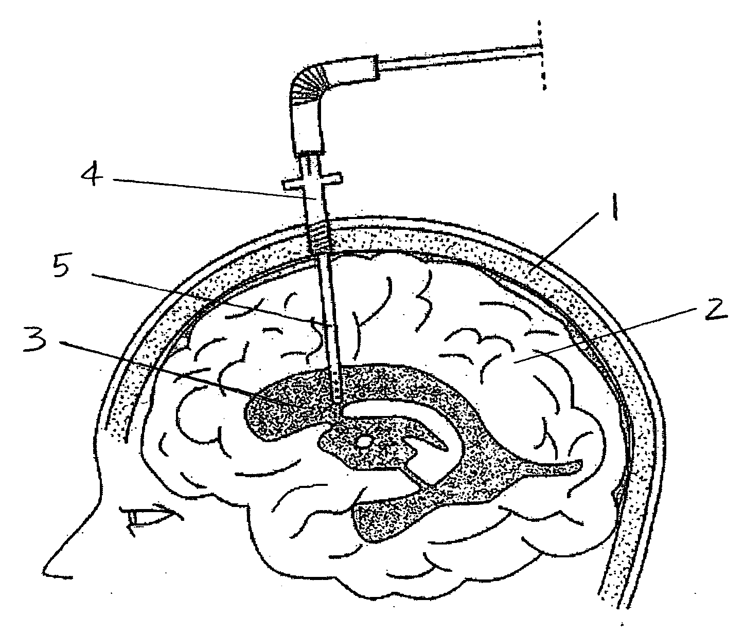 Central nervous system ultrasonic drain