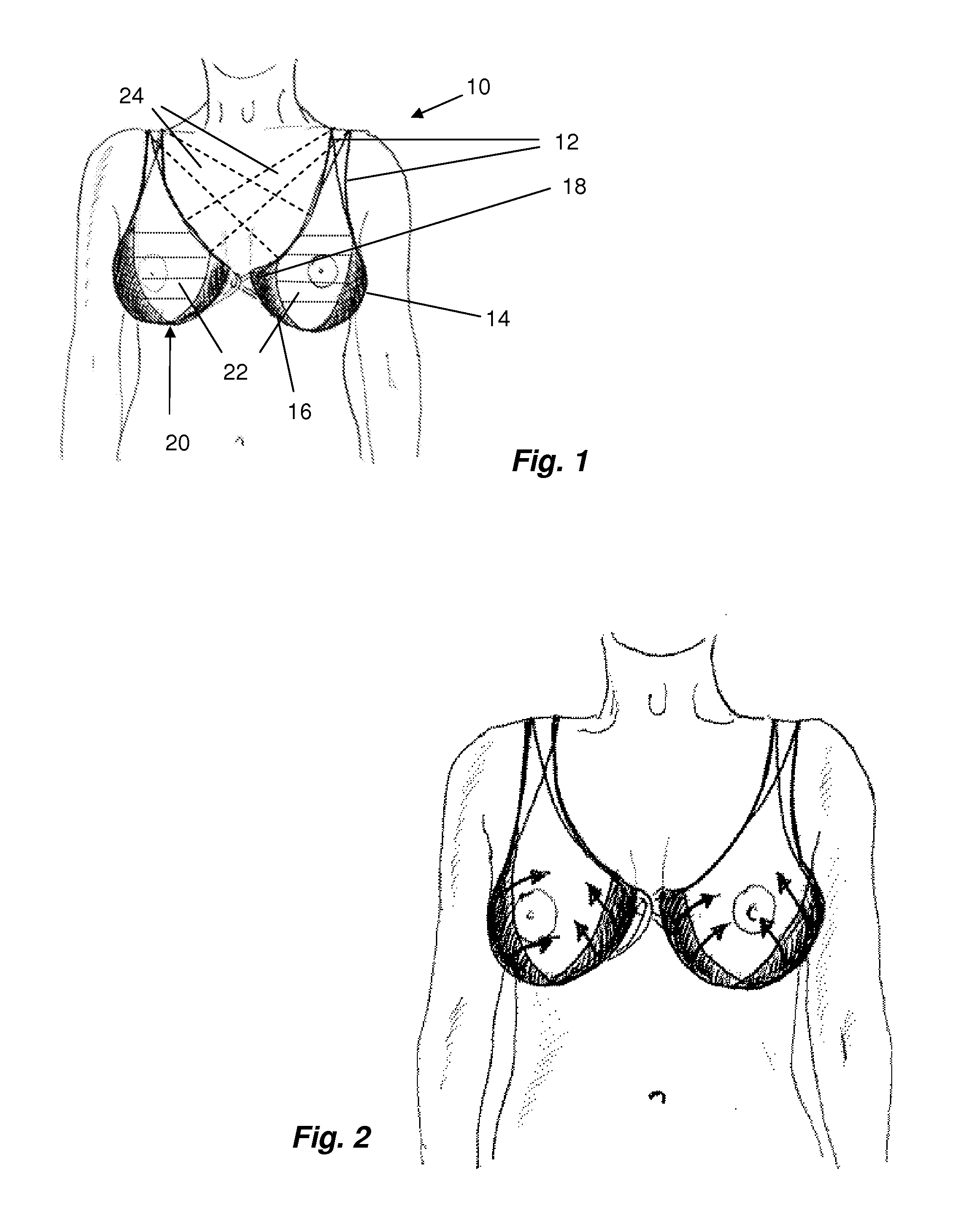 Breast support system for recumbent woman
