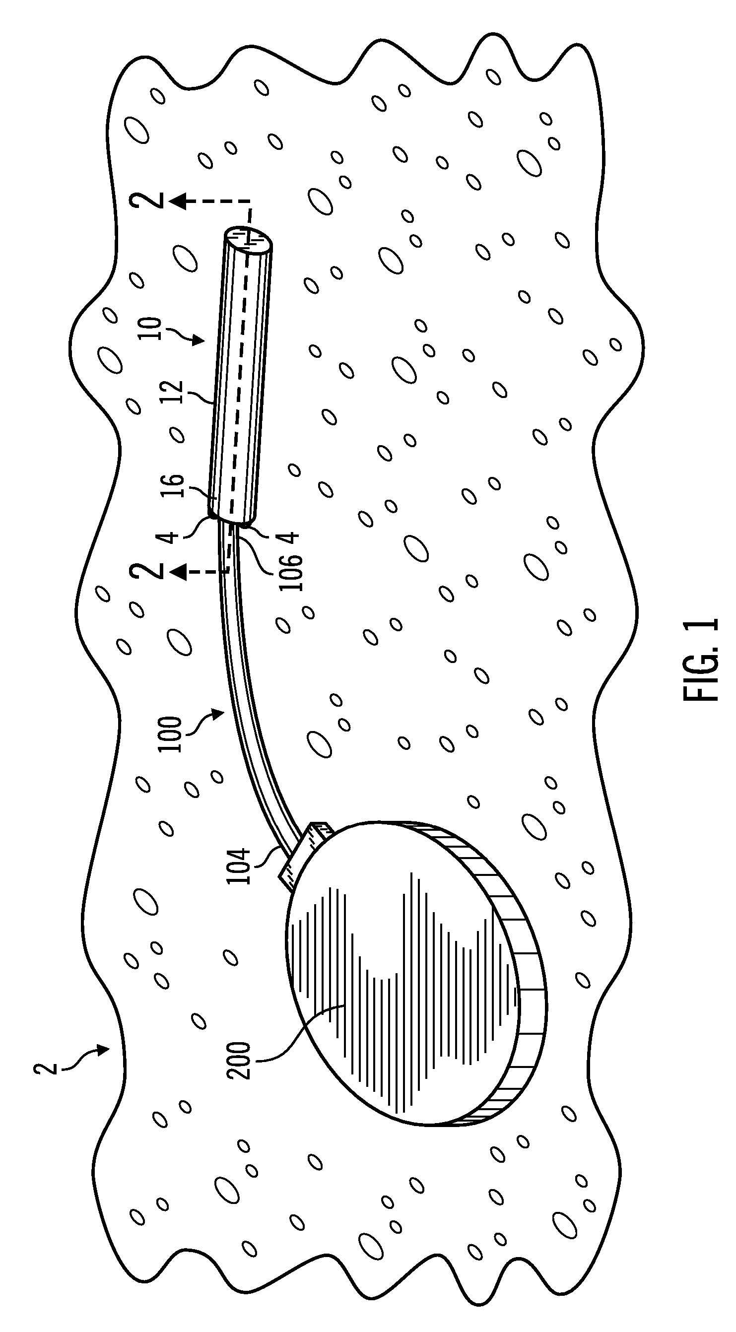 Reusable Infusion Site and Method of Using the Same