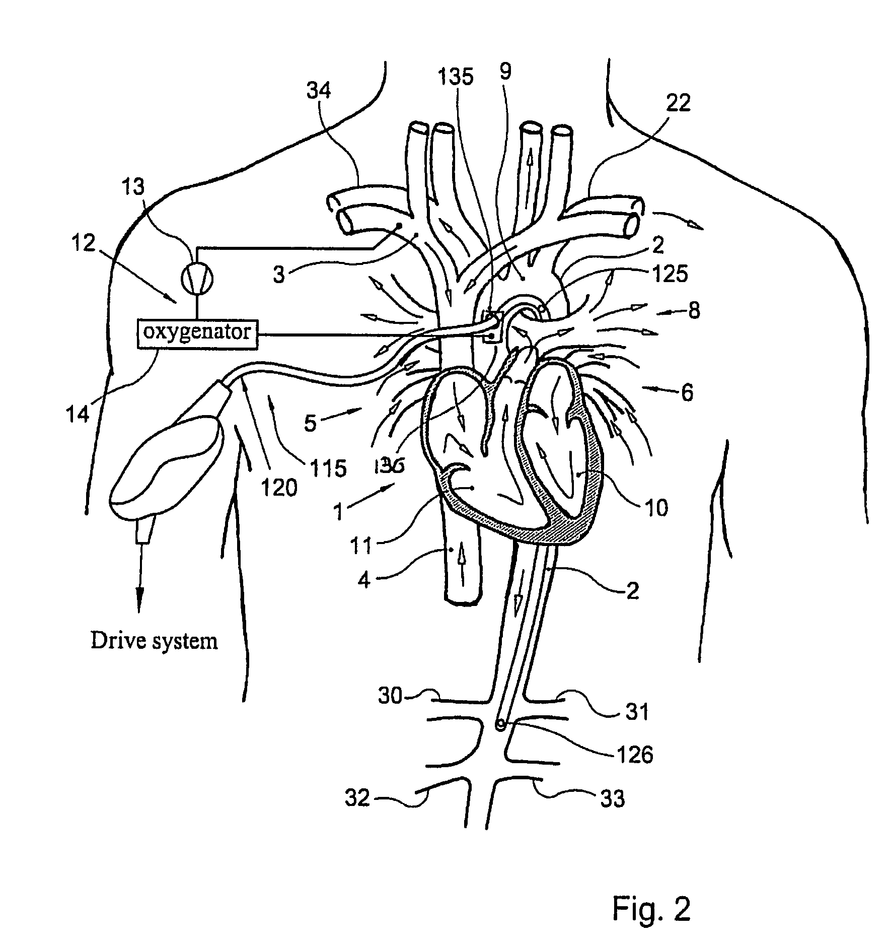 Catheter pump, catheter and fittings therefore and methods of using a catheter pump