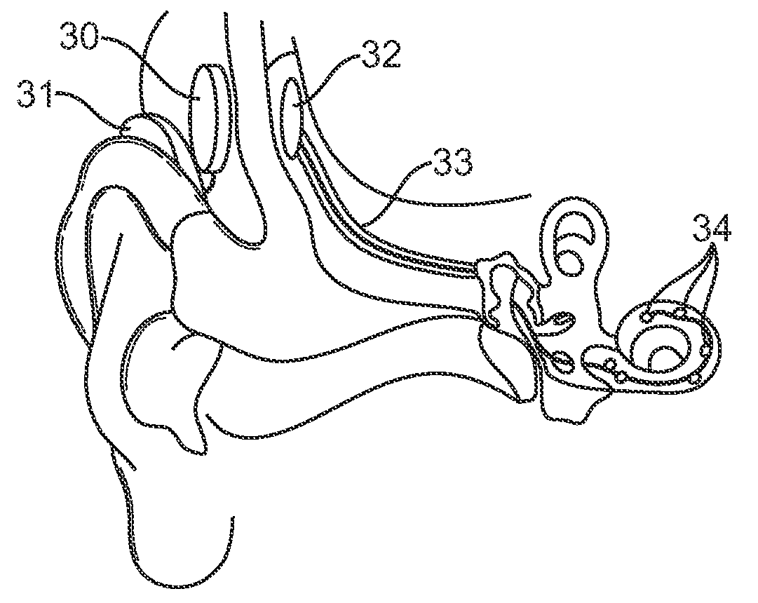 Systems and methods for implantable leadless cochlear stimulation