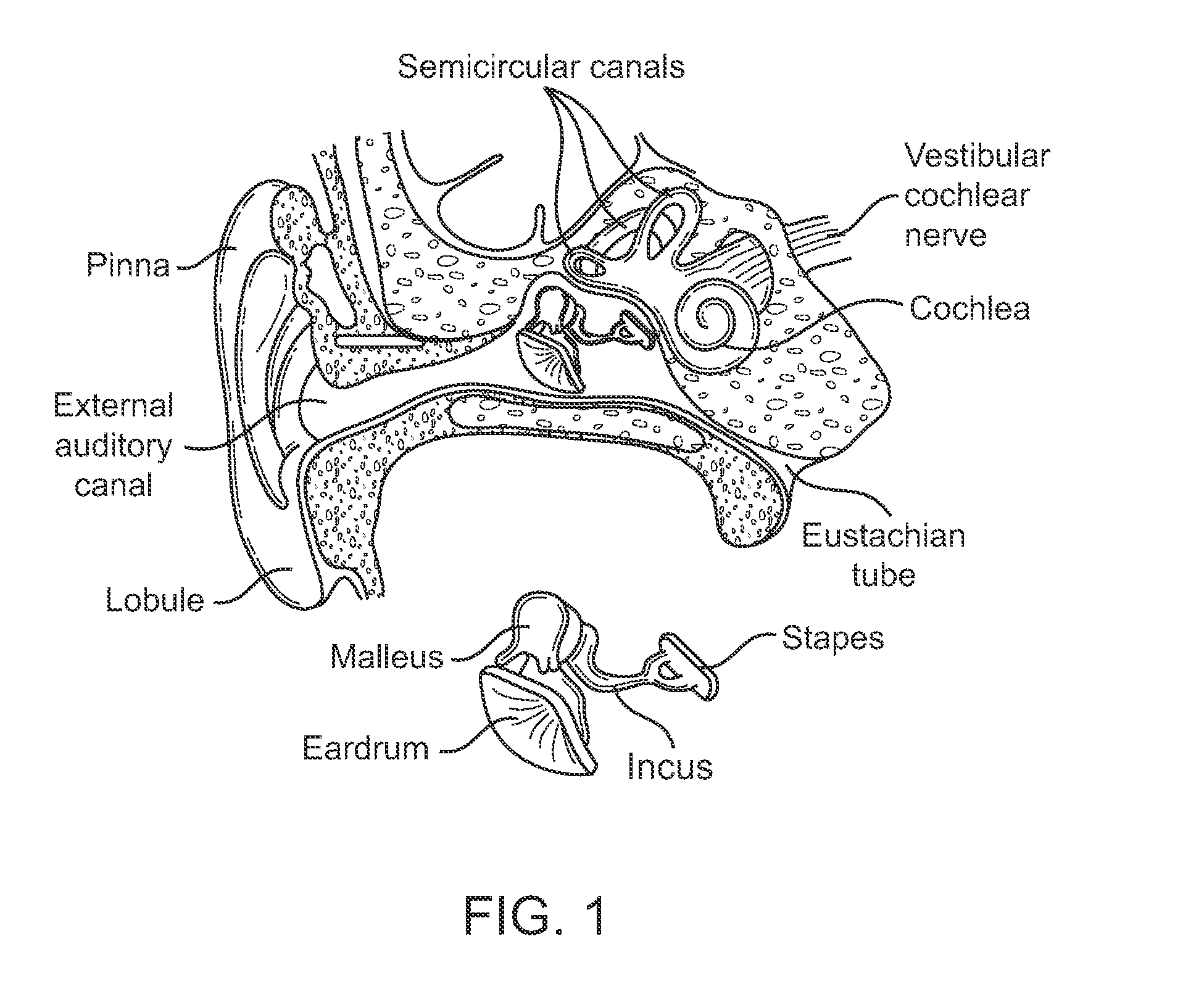 Systems and methods for implantable leadless cochlear stimulation