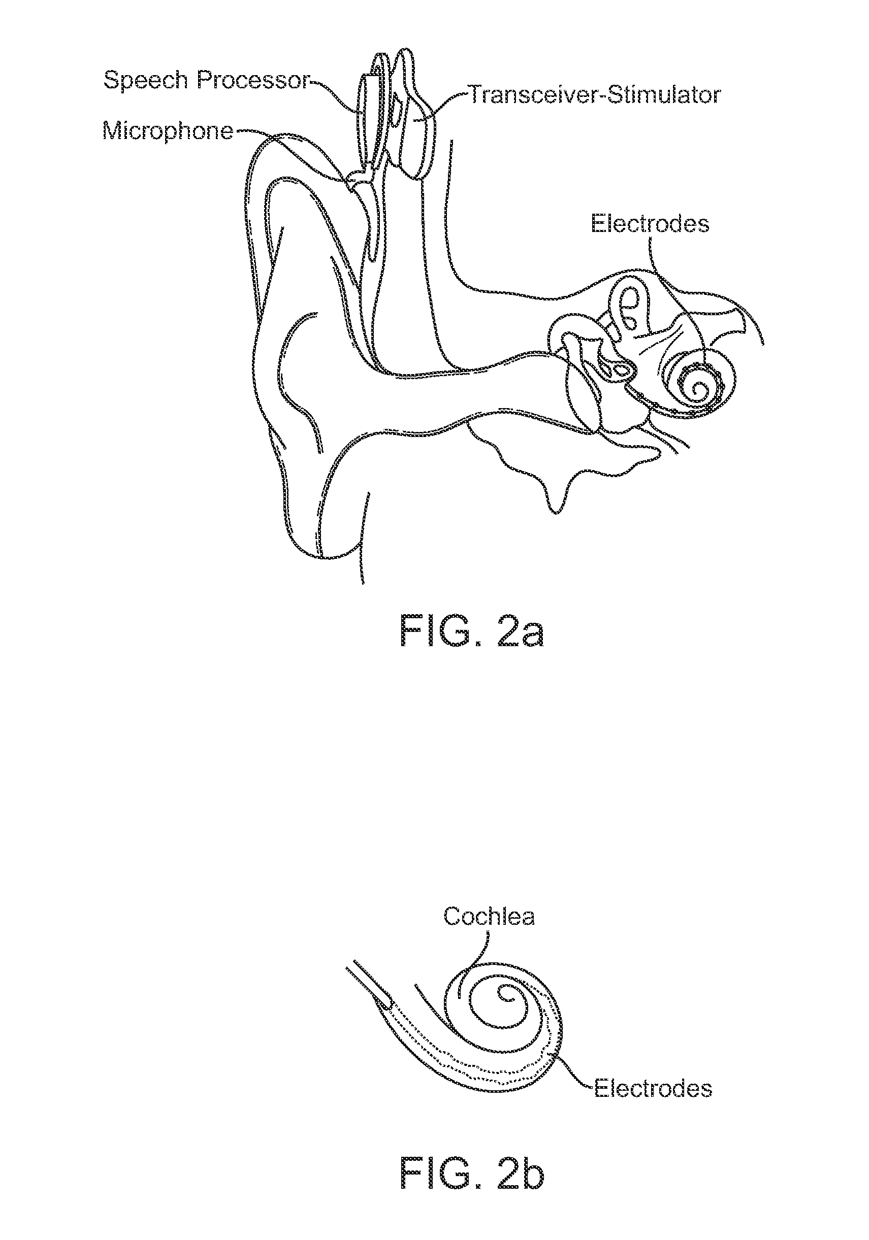 Systems and methods for implantable leadless cochlear stimulation