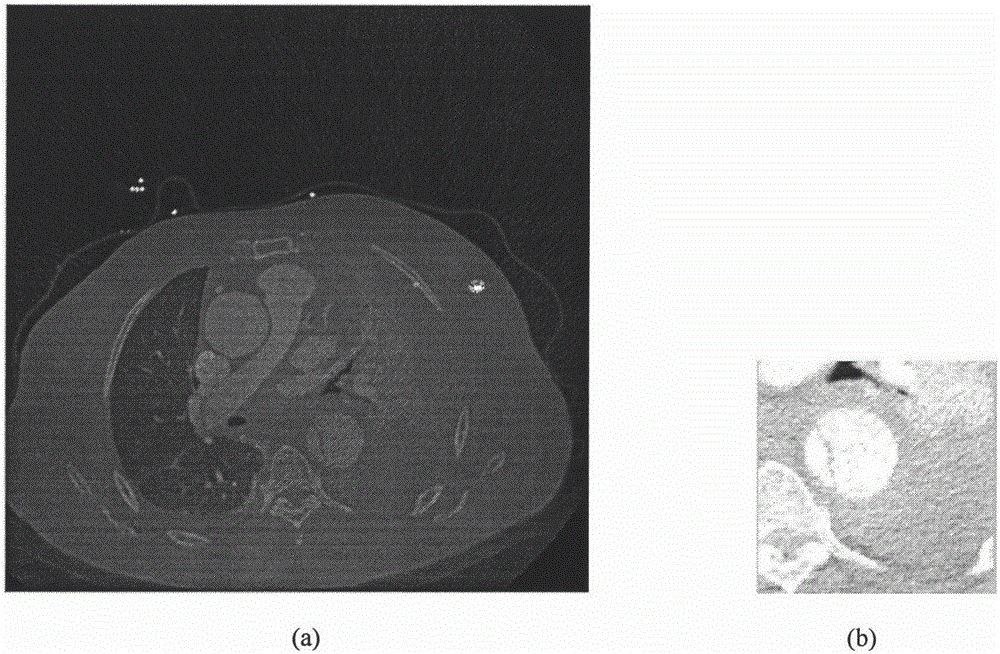 Human body thoracic and abdominal cavity CT image aorta segmentation method based on GVF Snake model