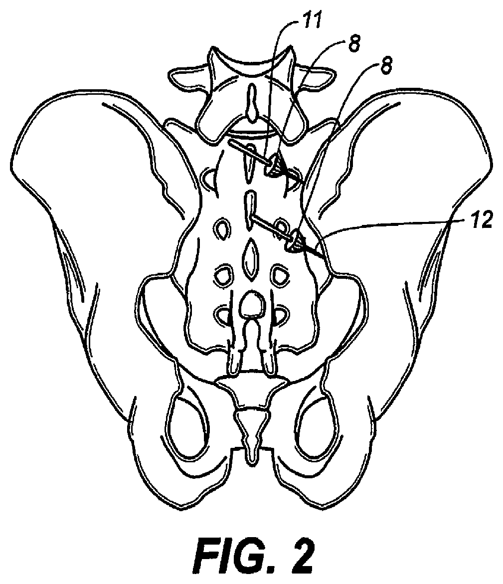 Minimally invasive surgical systems for fusion of the sacroiliac joint