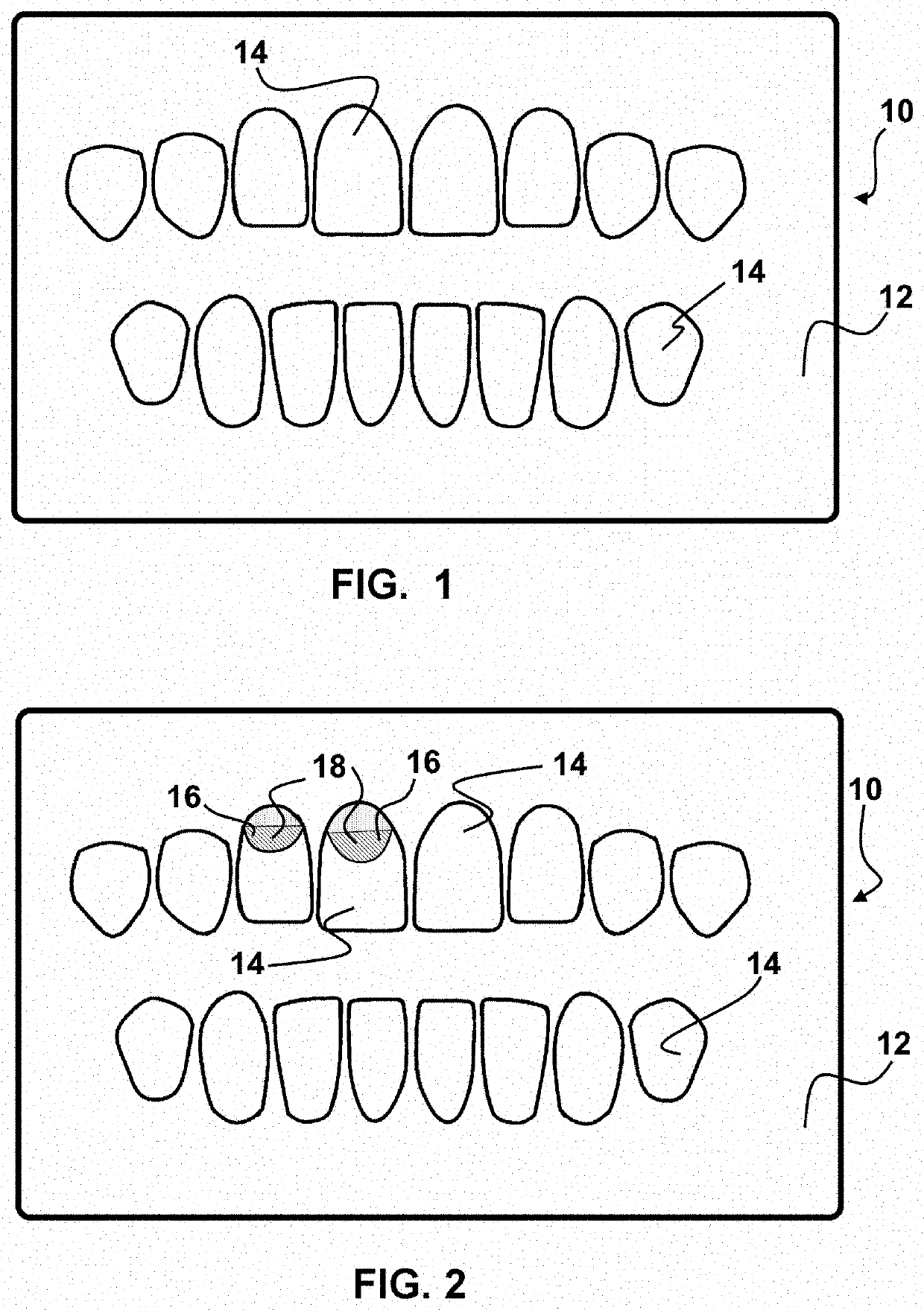 Removably Adherable Cosmetic Teeth Covers
