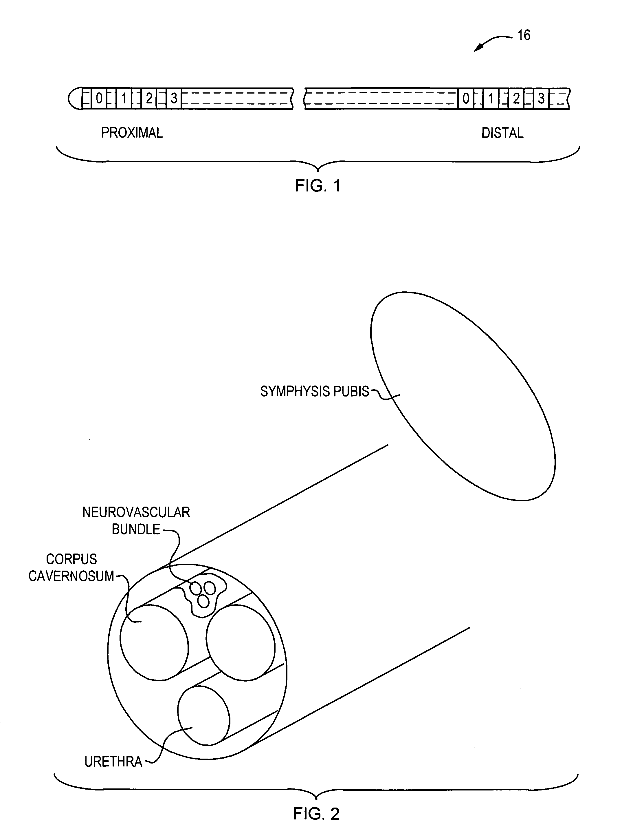 Implantable device and method for managing erectile dysfunction