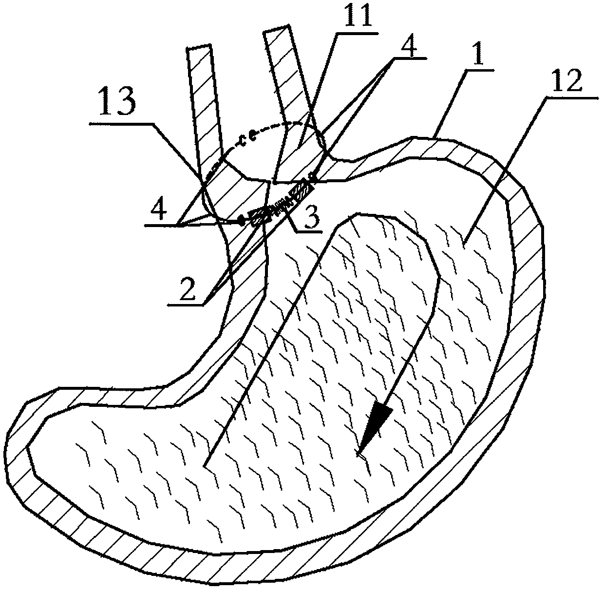 An auxiliary device for enhancing sphincter function