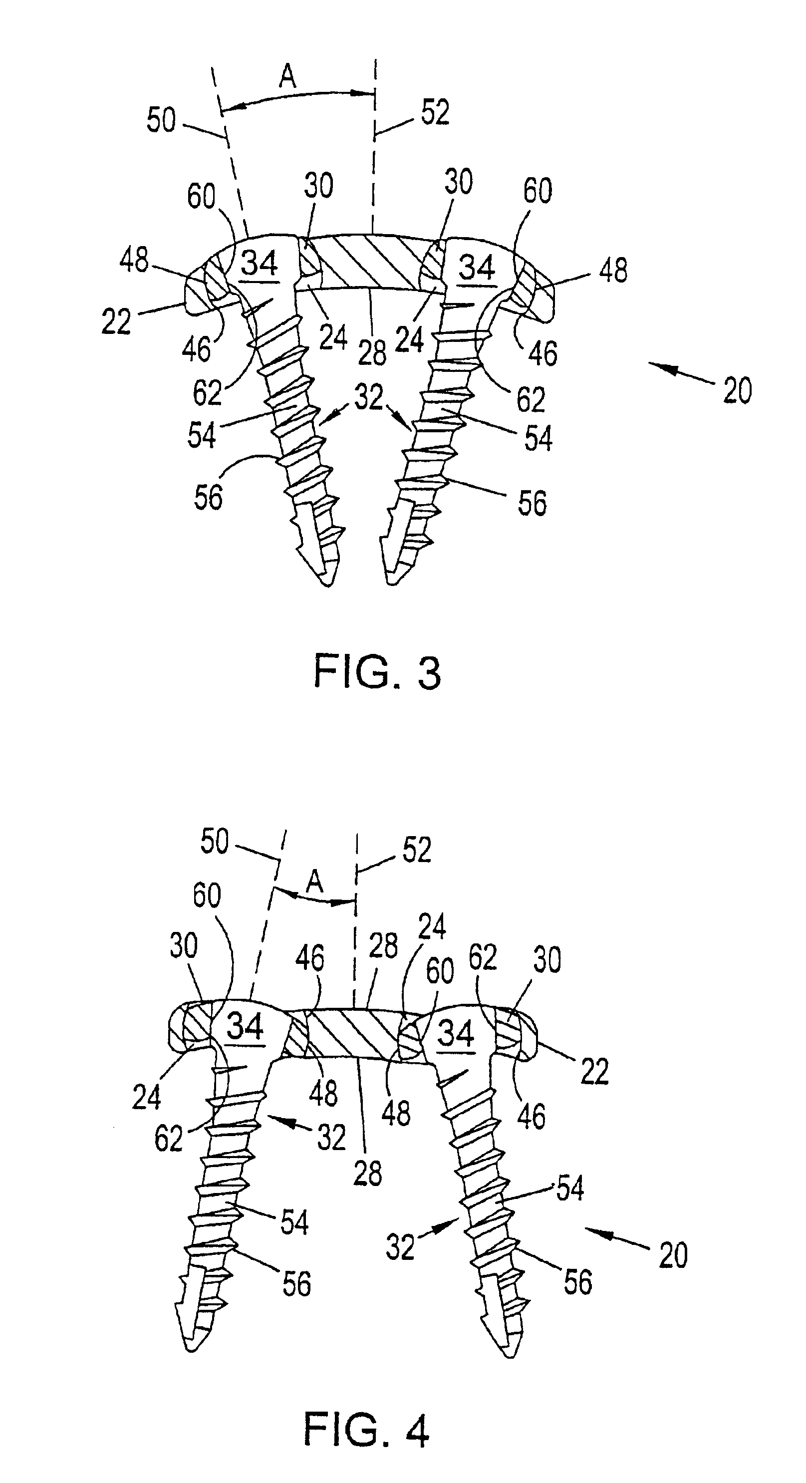 System and method for stabilizing the human spine with a bone plate