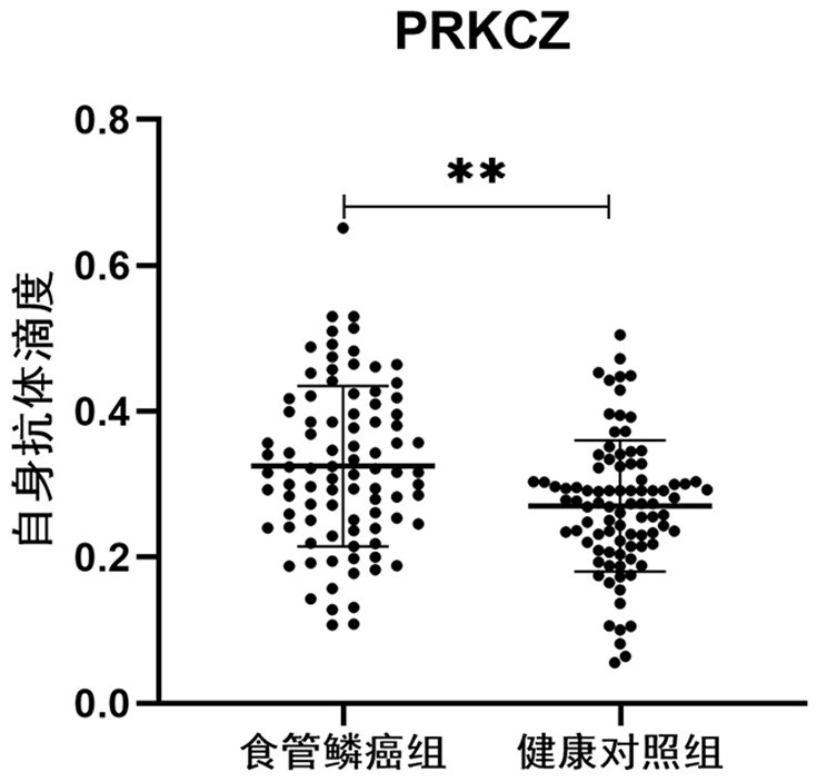 Application of PRKCZ autoantibody in auxiliary diagnosis of esophageal squamous carcinoma