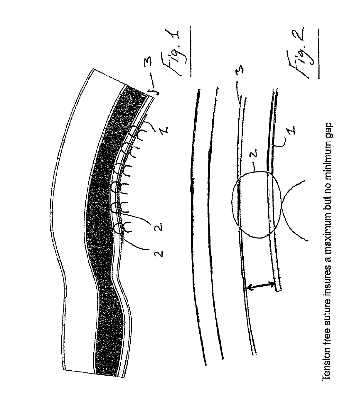 Suture device