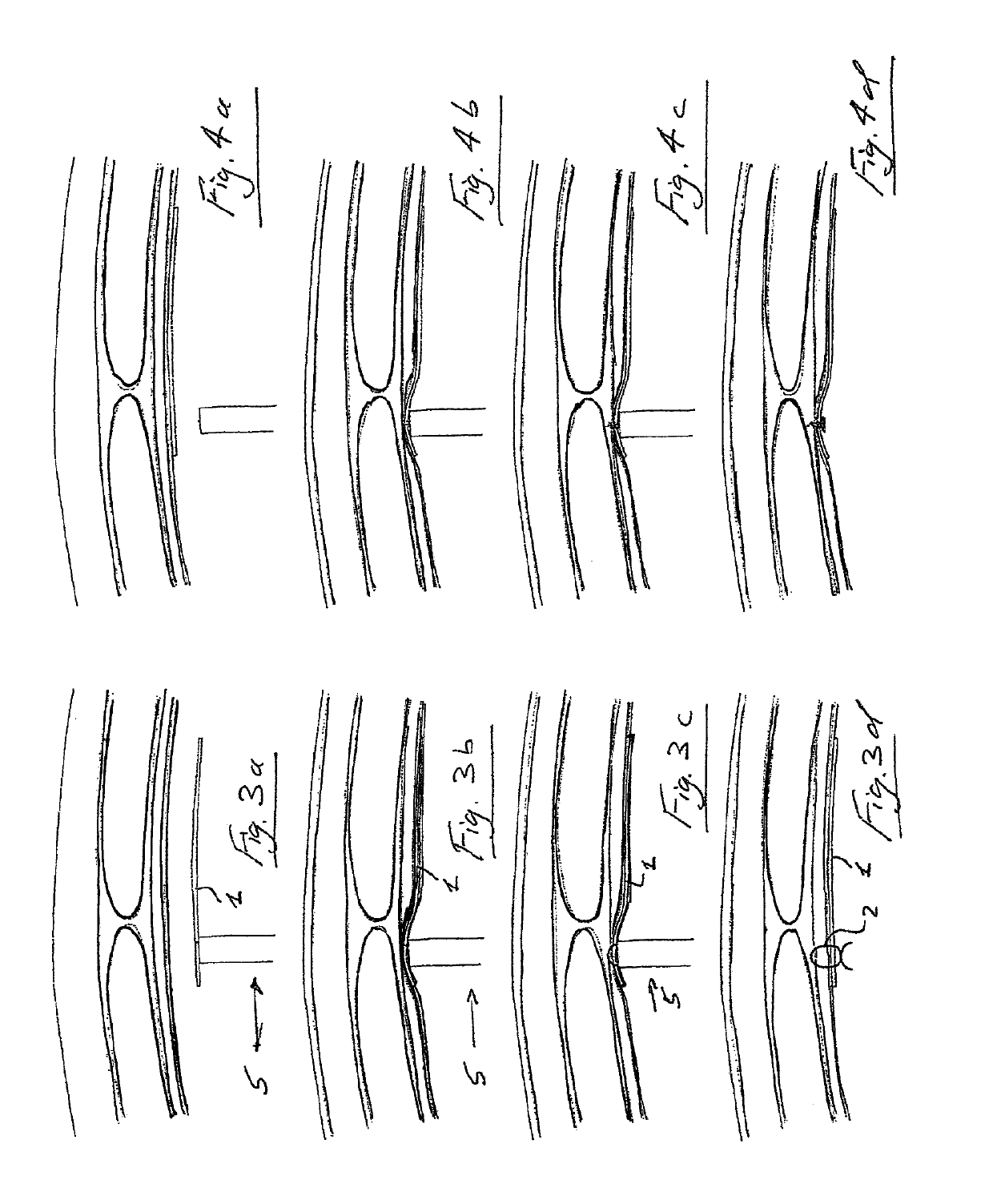 Suture device