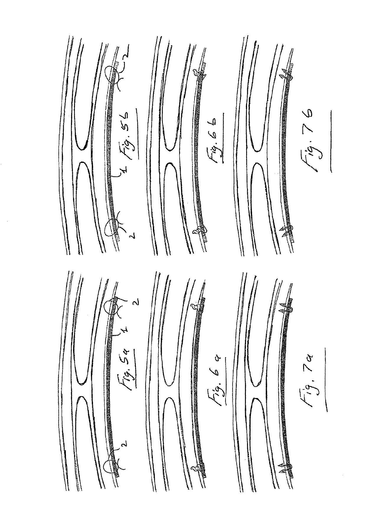 Suture device