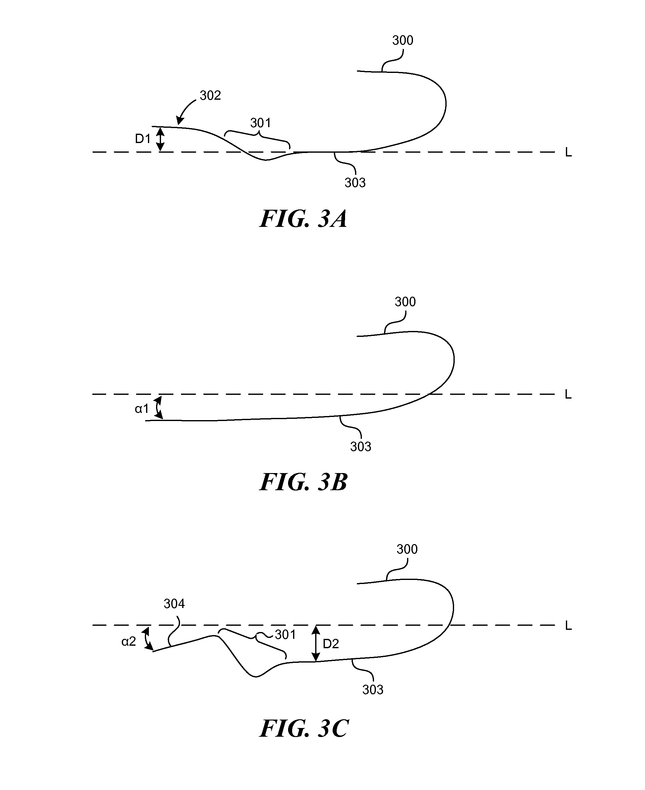 Systems and methods for endoluminal valve creation