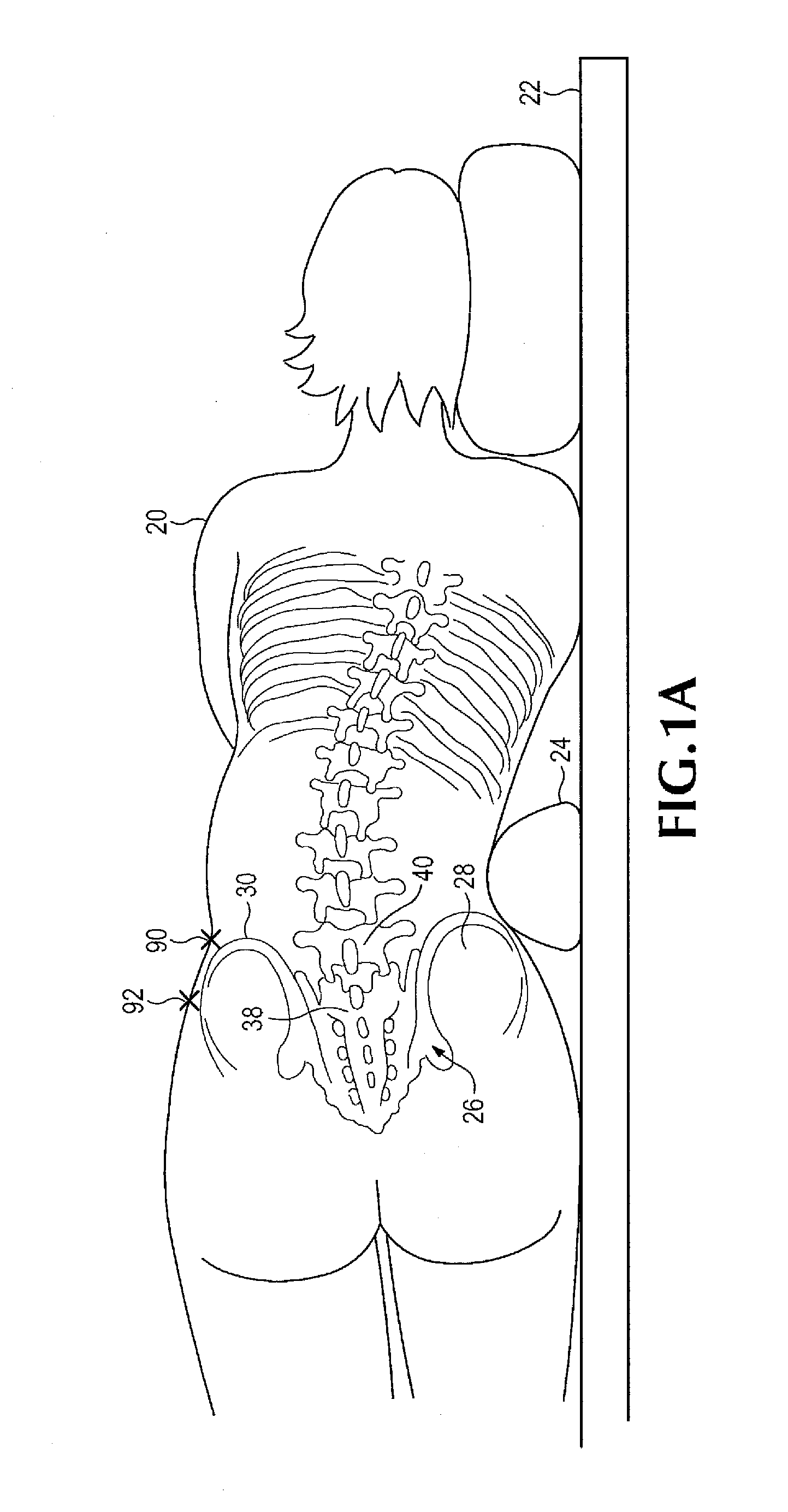 Method of retroperitoneal lateral insertion of spinal implants