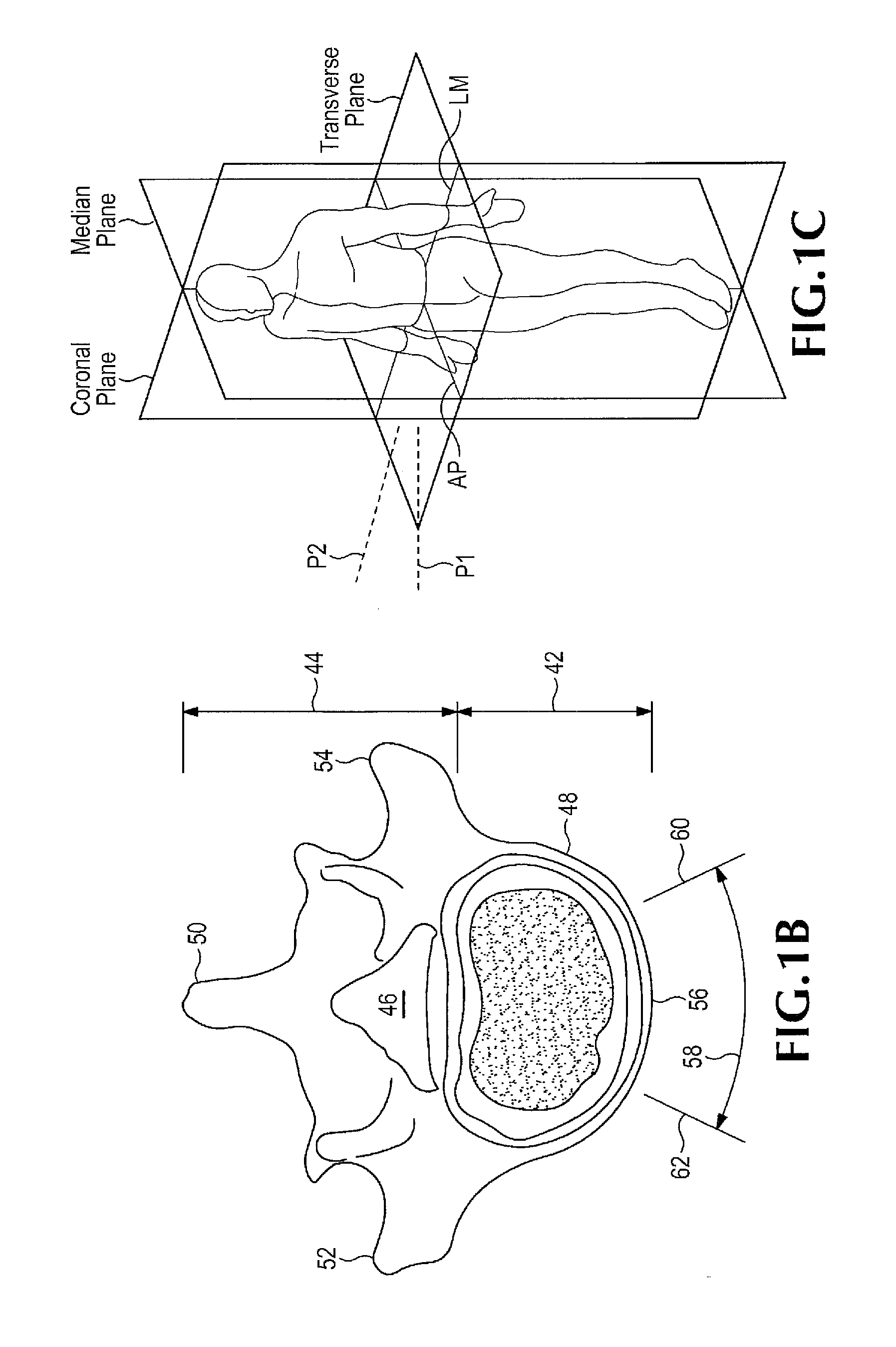 Method of retroperitoneal lateral insertion of spinal implants