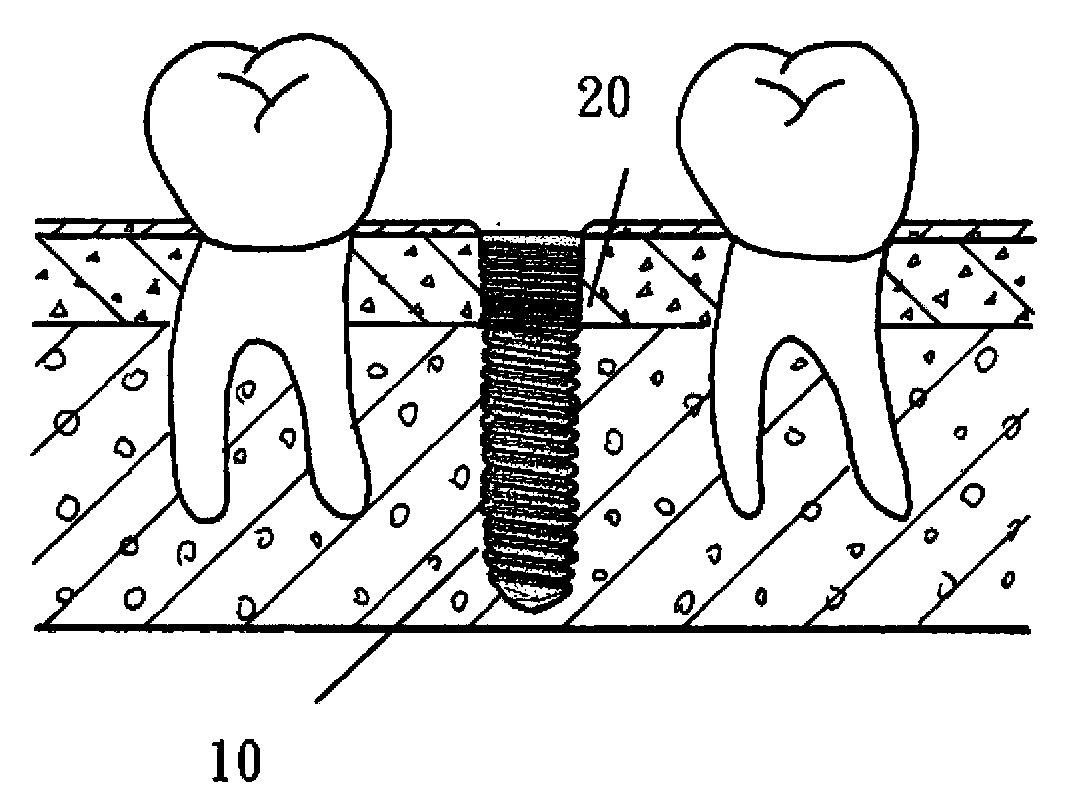 Dental implant having different surface treatment areas