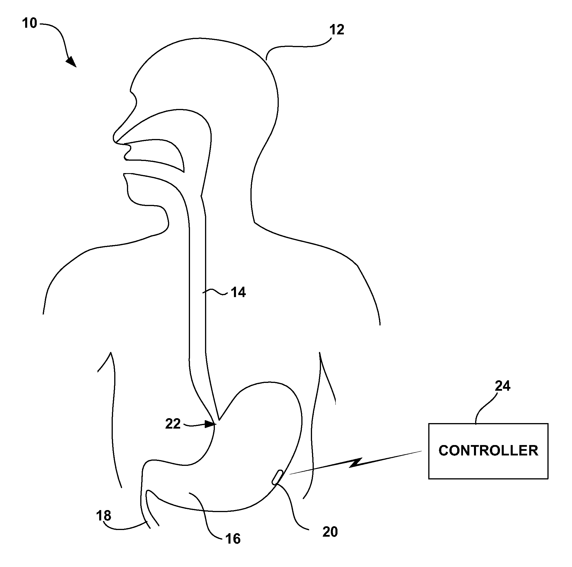 Intra-Luminal Device for Gastrointestinal Electrical Stimulation