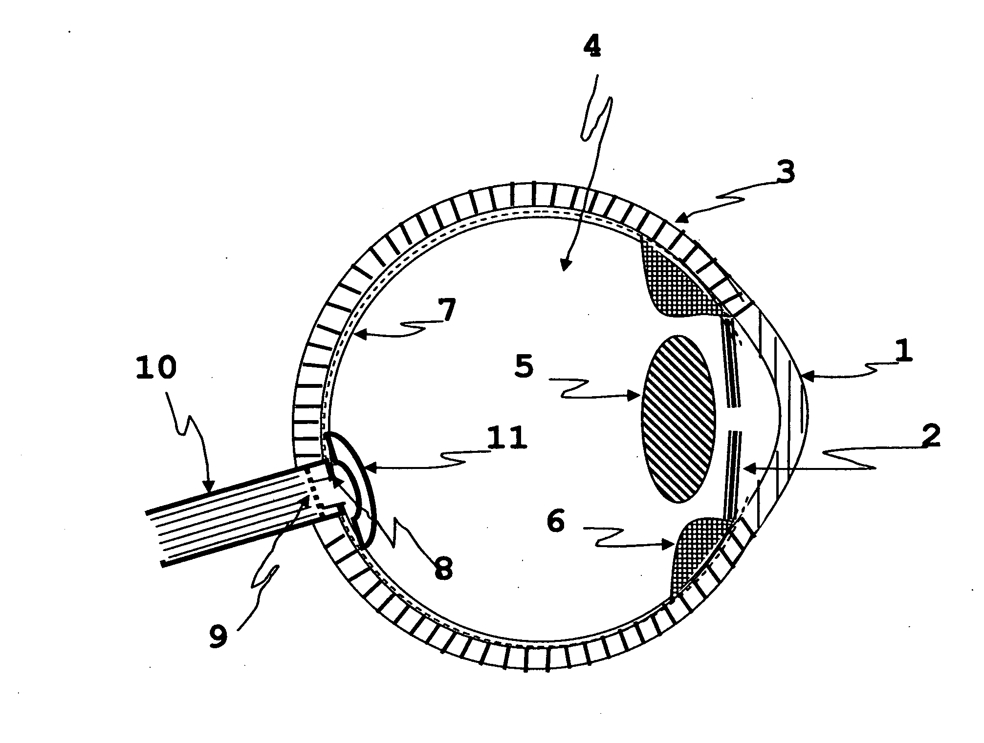 Apparatus and method for preventing glaucomatous optic neuropathy