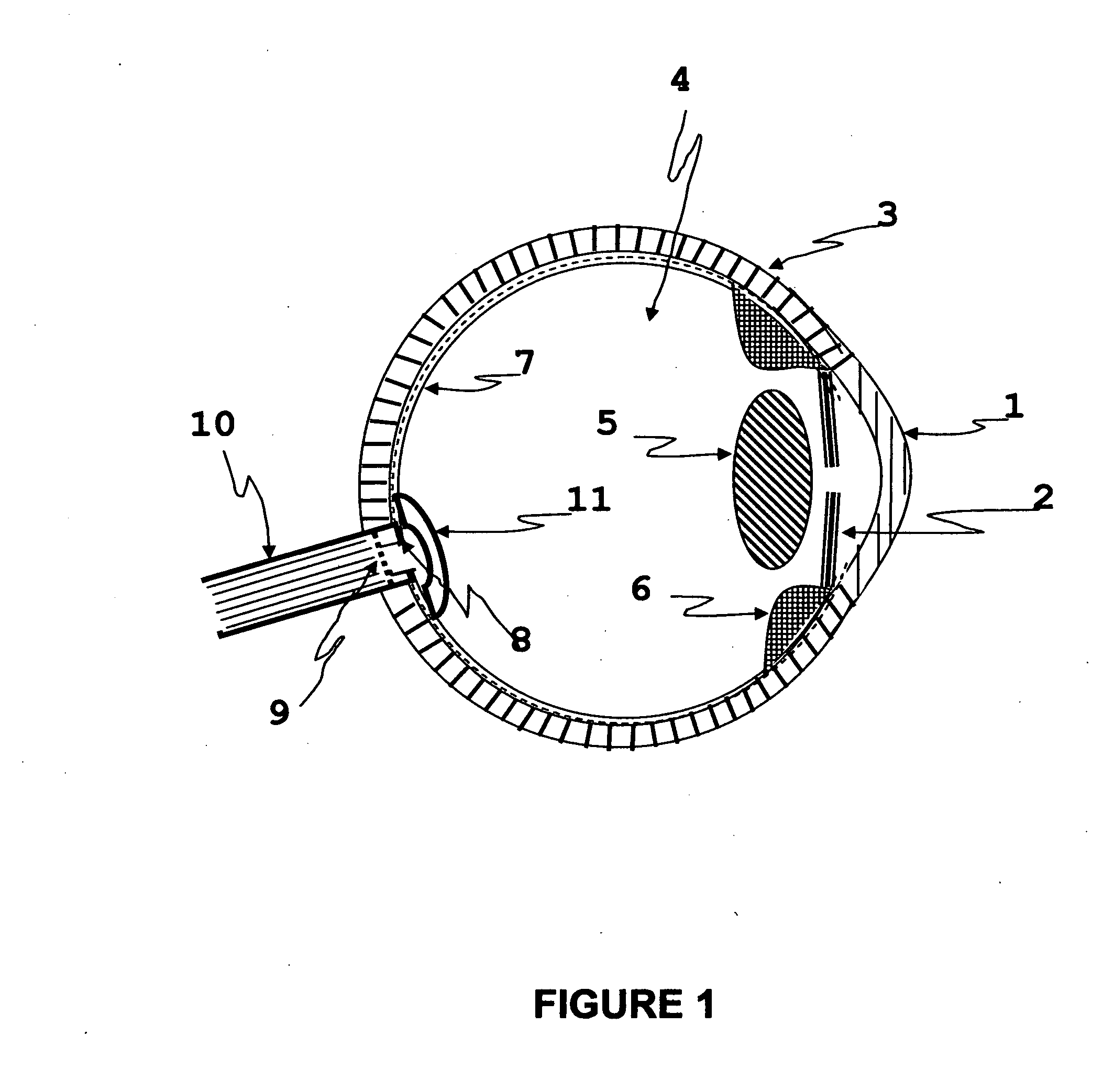 Apparatus and method for preventing glaucomatous optic neuropathy